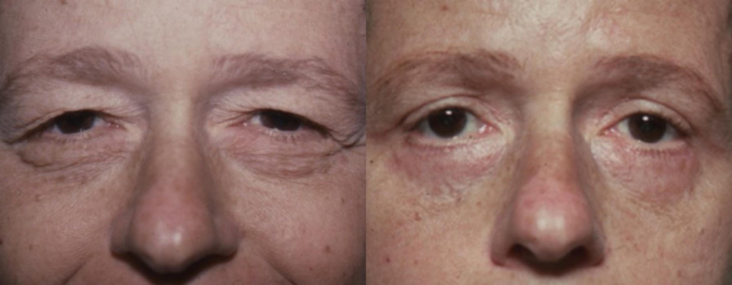 Blepharoplasty Before & After Photo | New Jersey & Pennsylvania, | The Derm Group
