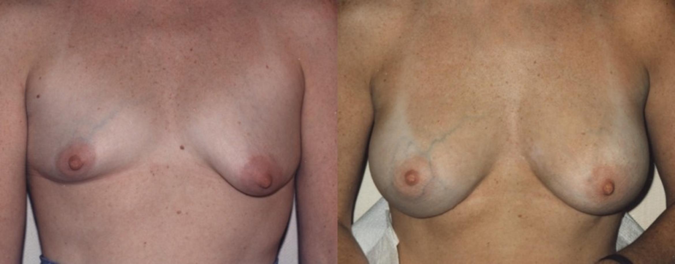 Breast Augmentation Before & After Photo | New Jersey & Pennsylvania, | The Derm Group