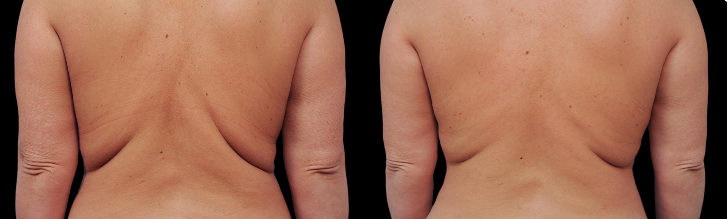 CoolSculpting® Before & After Photo | New Jersey & Pennsylvania, | The Derm Group