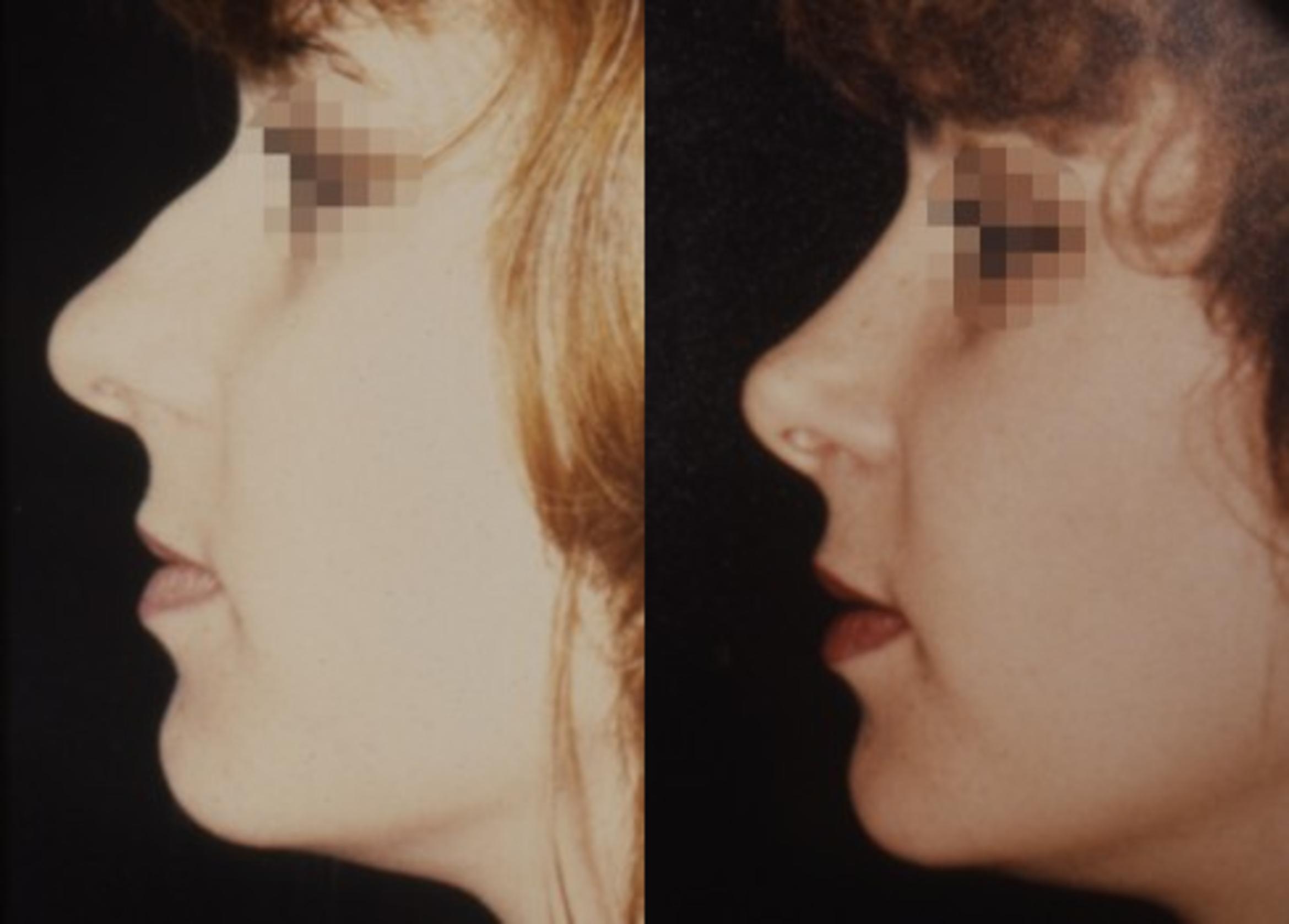 Rhinoplasty Before & After Photo | New Jersey & Pennsylvania, | The Derm Group