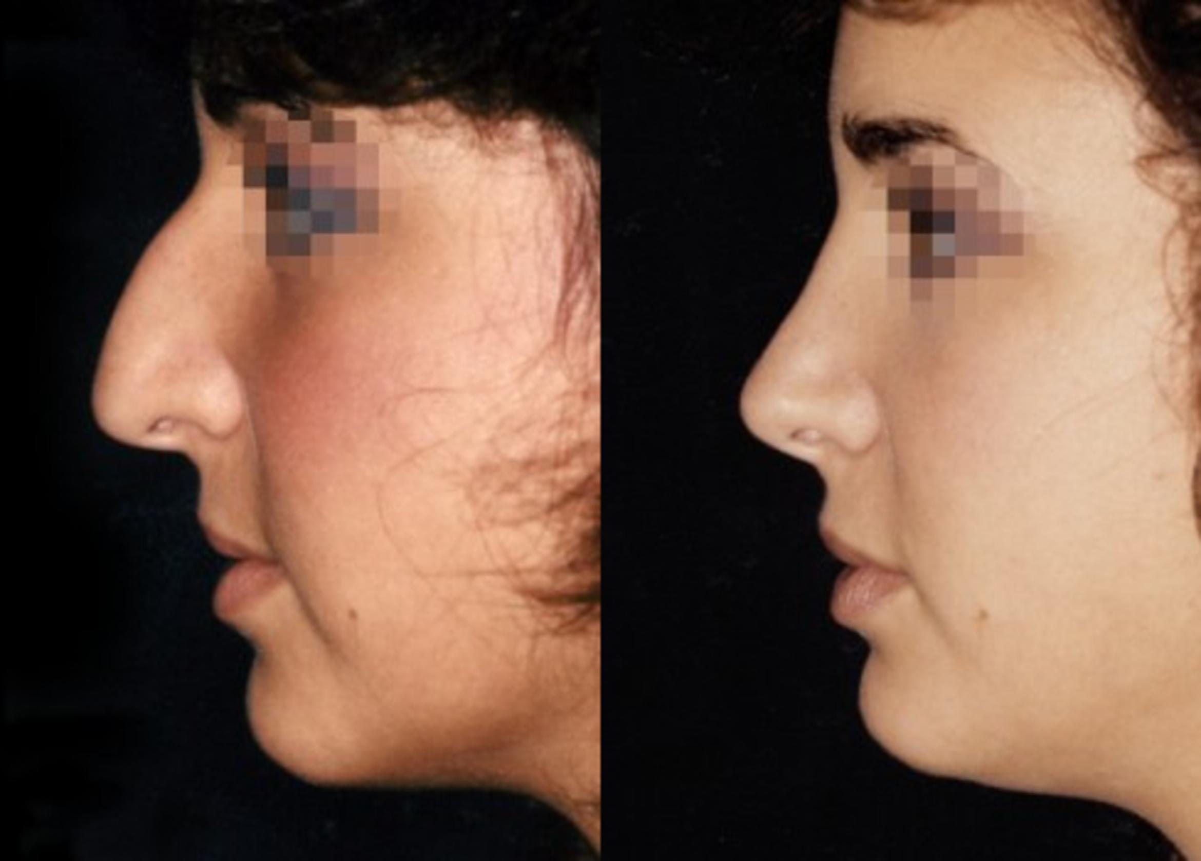 Rhinoplasty Before & After Photo | New Jersey & Pennsylvania, | The Derm Group