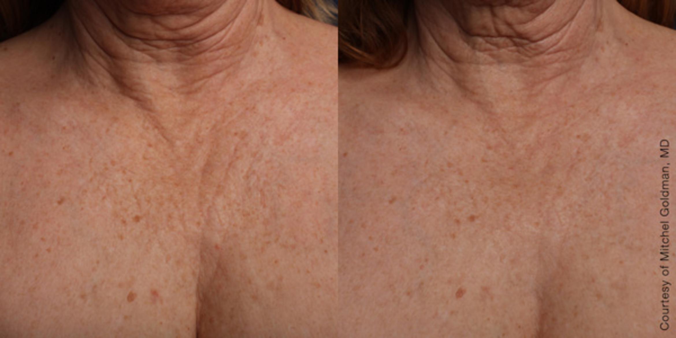 Ultherapy® Before & After Photo | Jersey City, New Jersey | The Derm Group