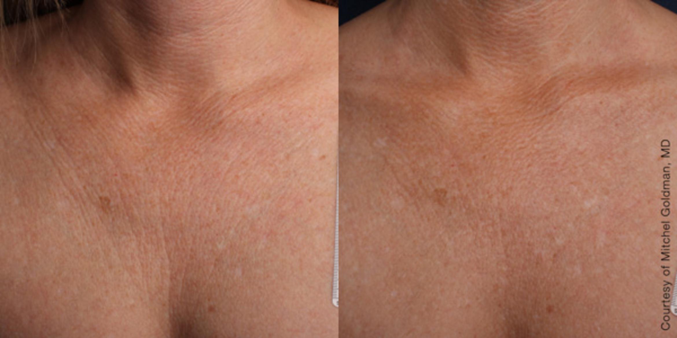 Ultherapy® Before & After Photo | Jersey City, New Jersey | The Derm Group