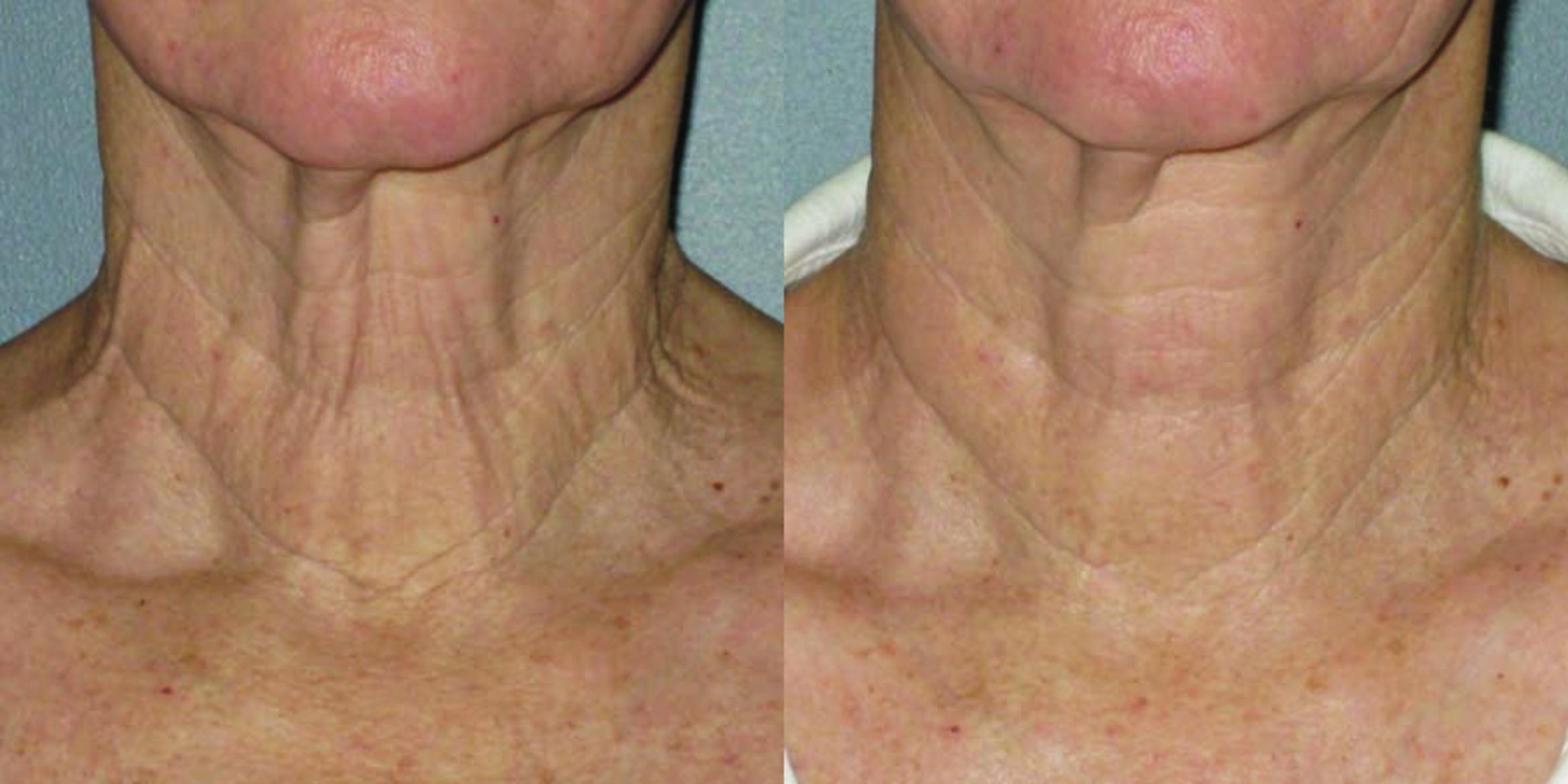 Ultherapy® Before & After Photo | Jersey City, New Jersey | The Derm Group