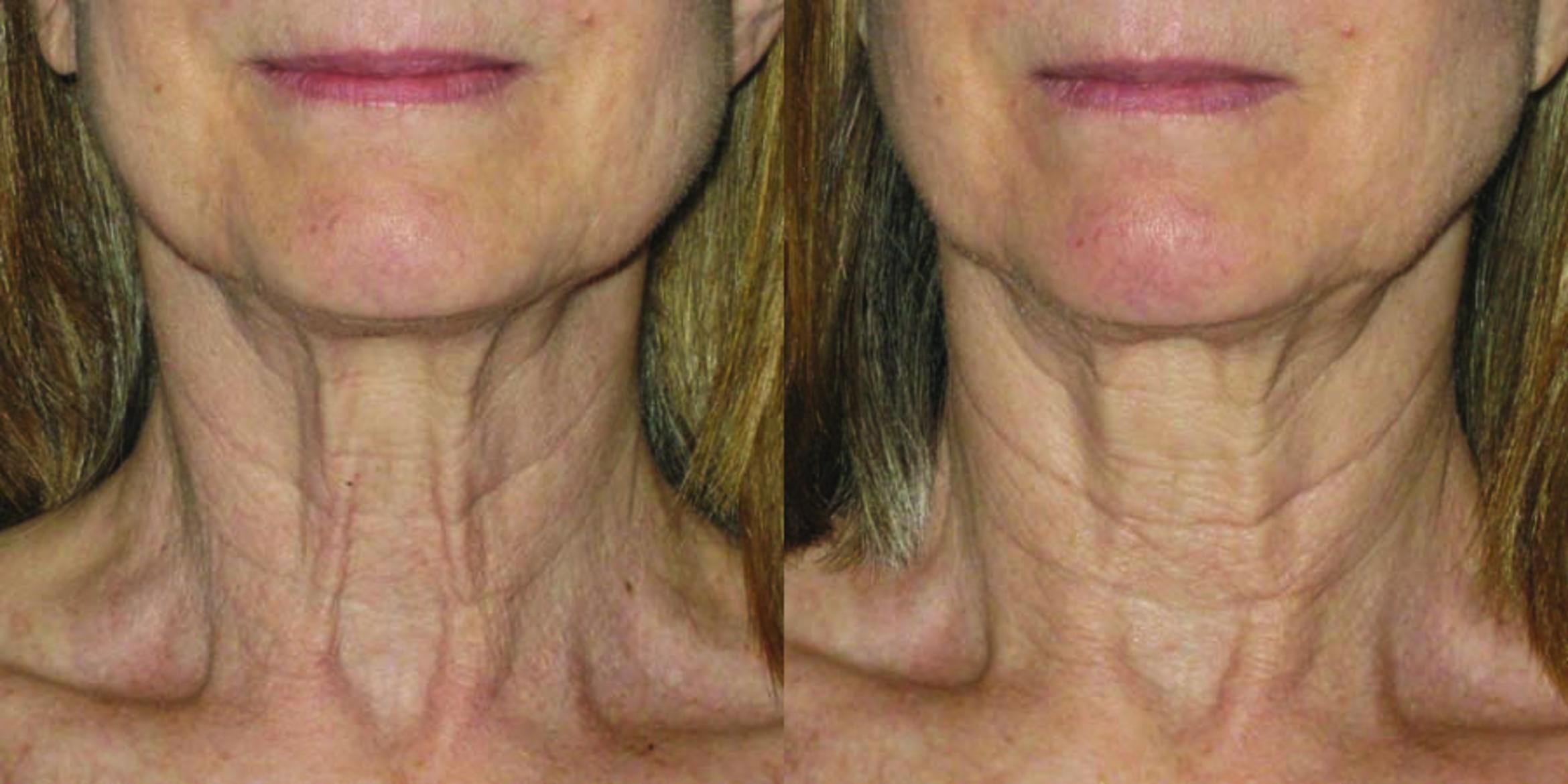 Ultherapy® Before & After Photo | Jersey City, New Jersey | The Derm Group