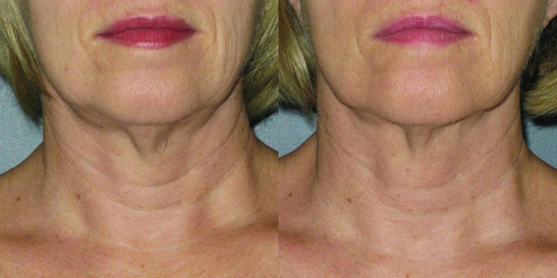 Ultherapy® Before & After Photo | Jersey City, New Jersey | The Derm Group