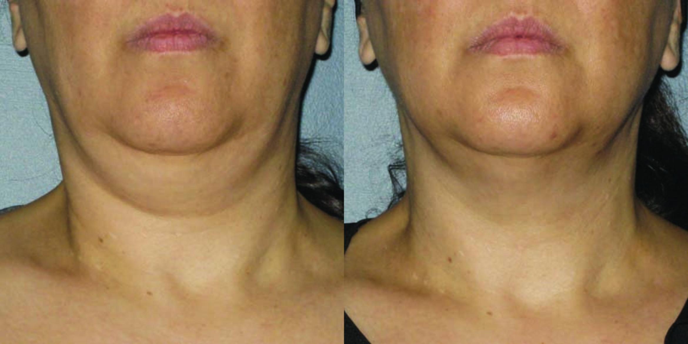 Ultherapy® Before & After Photo | Jersey City, New Jersey | The Derm Group