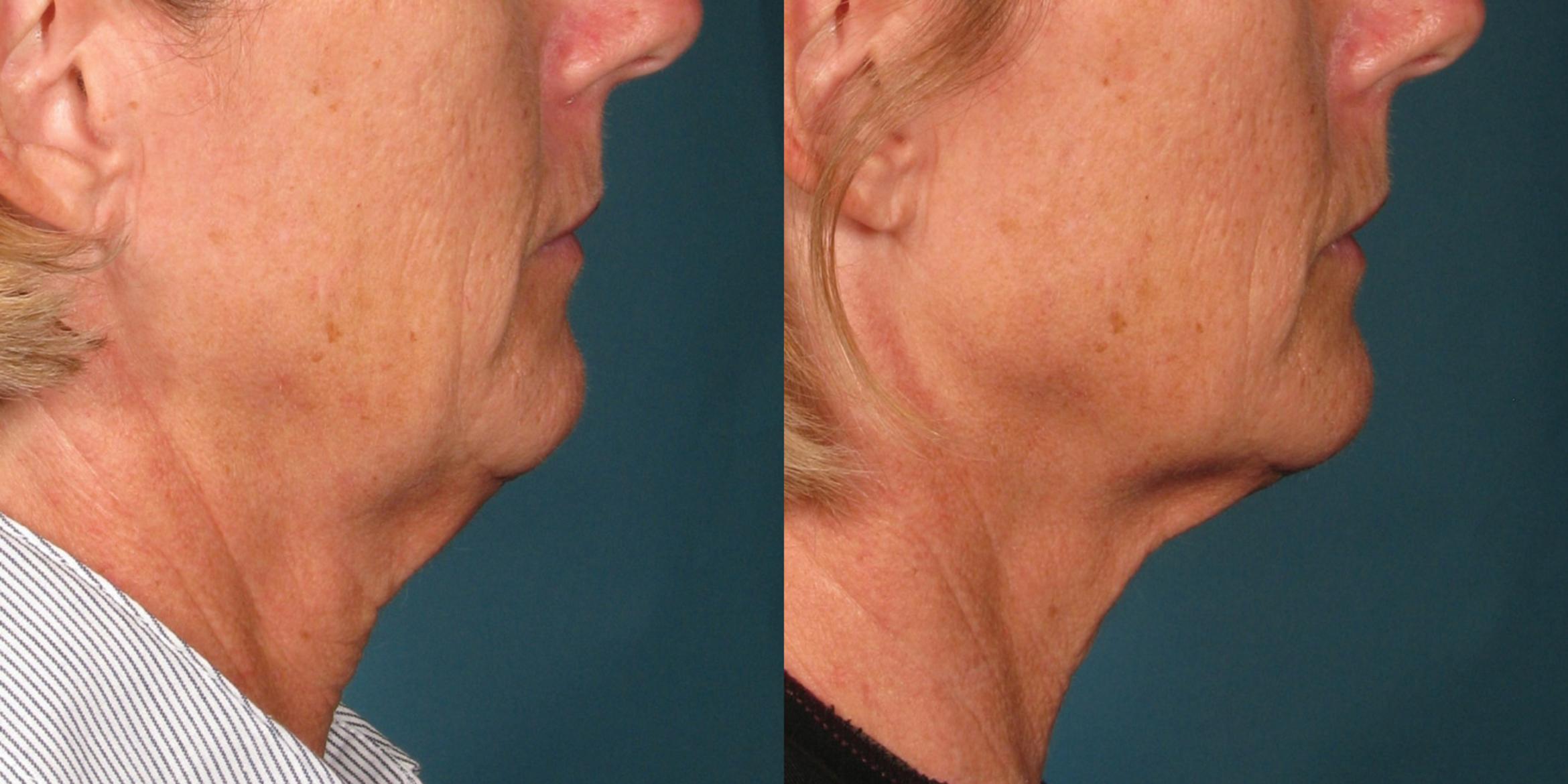 Ultherapy® Before & After Photo | Jersey City, New Jersey | The Derm Group