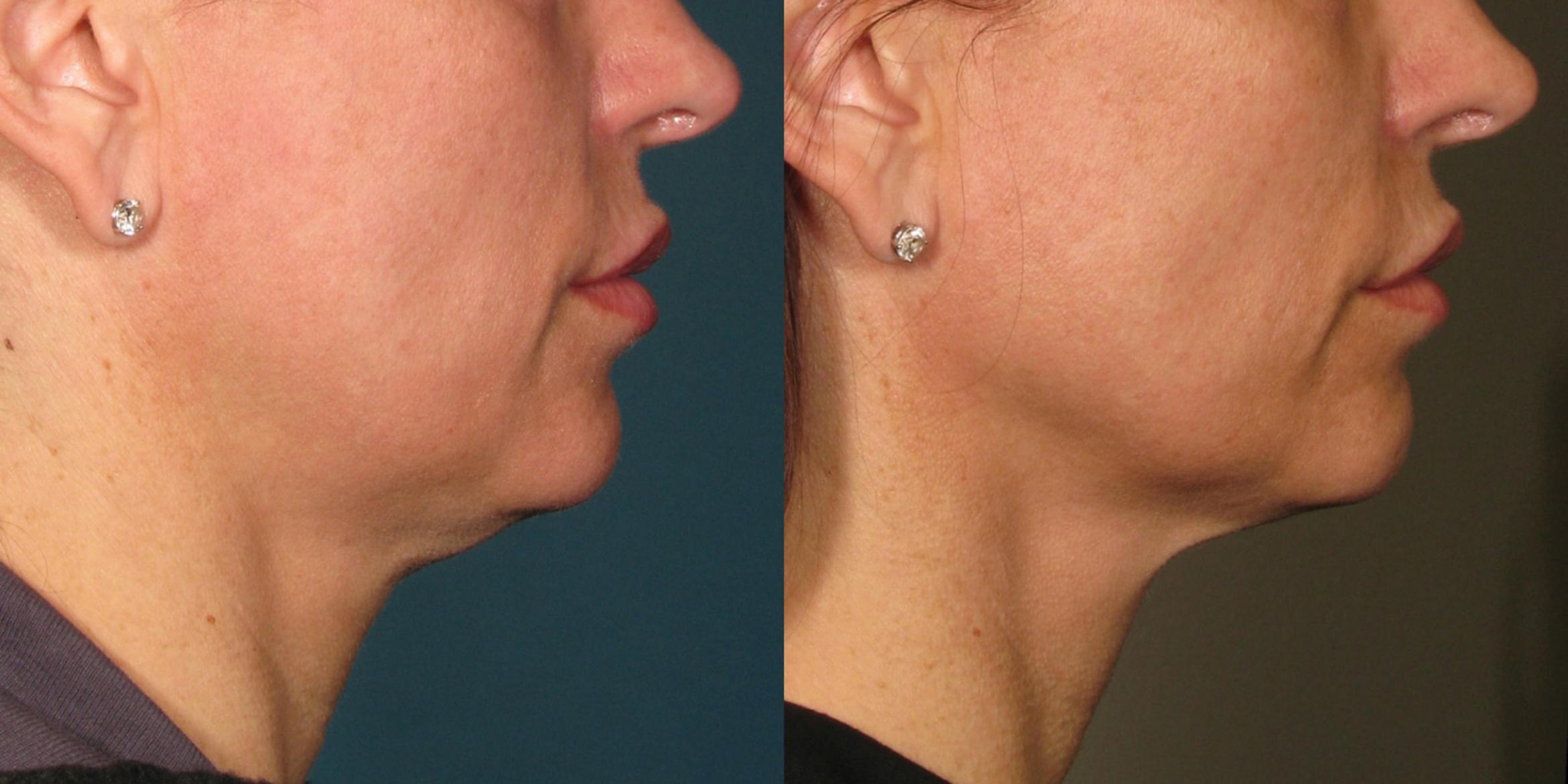 Ultherapy® Before & After Photo | Jersey City, New Jersey | The Derm Group