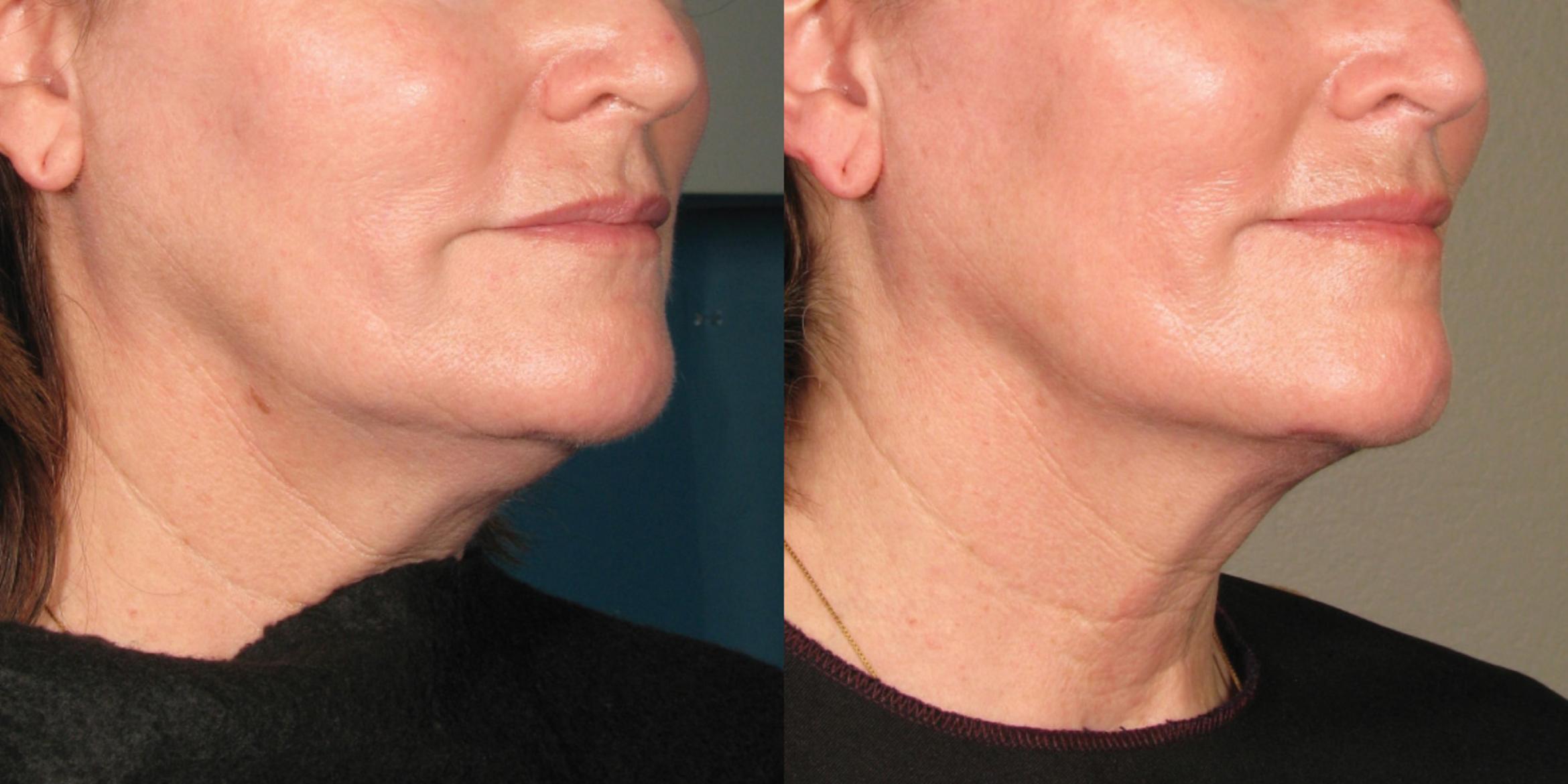 Ultherapy® Before & After Photo | Jersey City, New Jersey | The Derm Group
