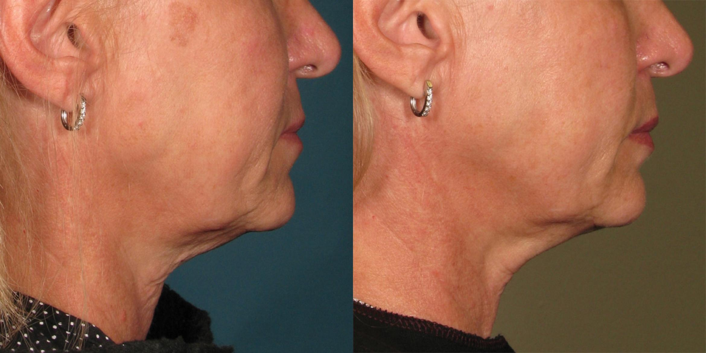 Ultherapy® Before & After Photo | Jersey City, New Jersey | The Derm Group