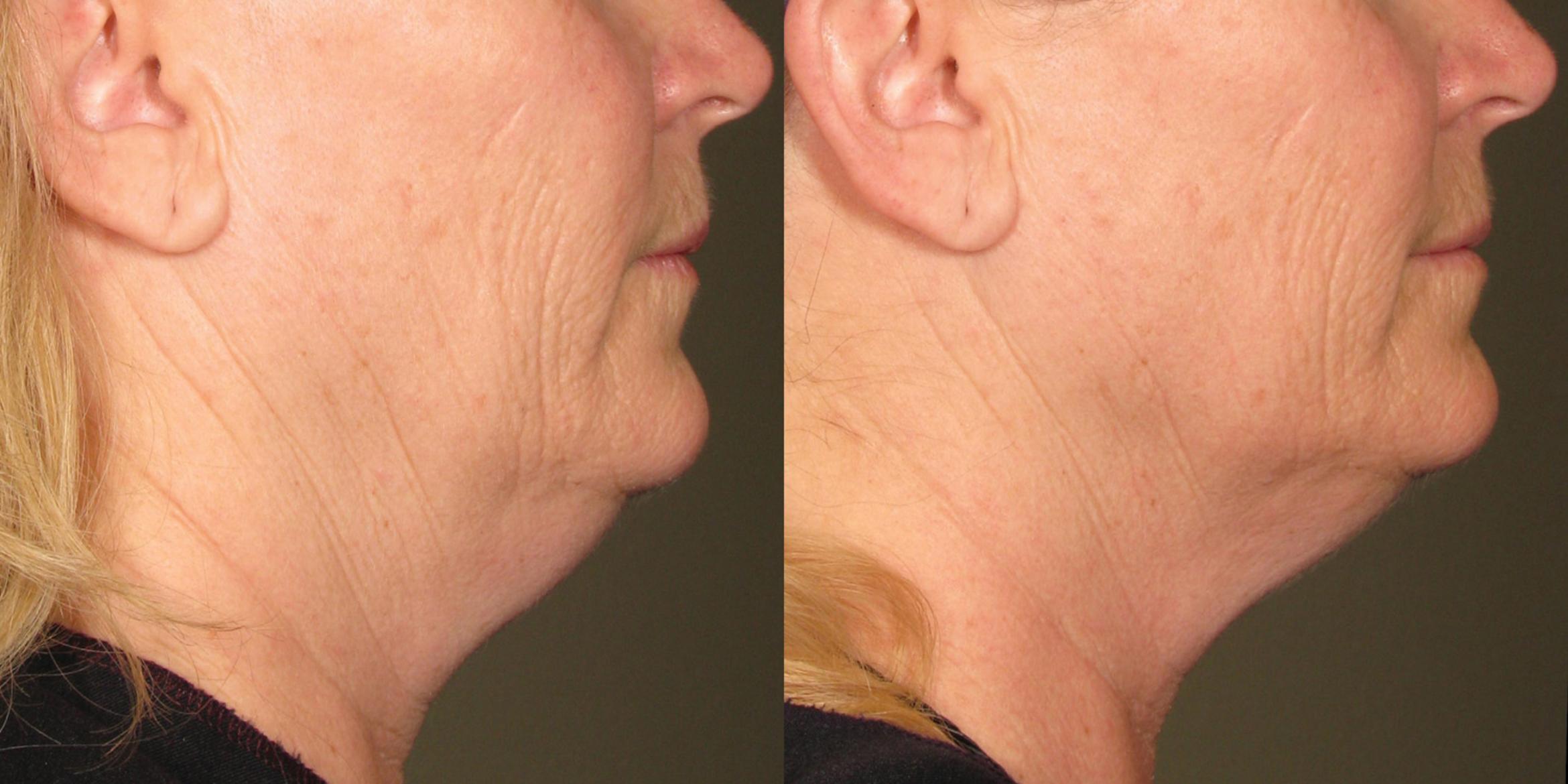 Ultherapy® Before & After Photo | Jersey City, New Jersey | The Derm Group