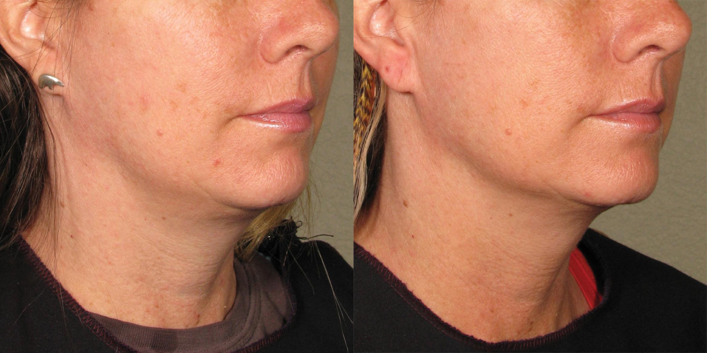Ultherapy® Before & After Photo | Jersey City, New Jersey | The Derm Group