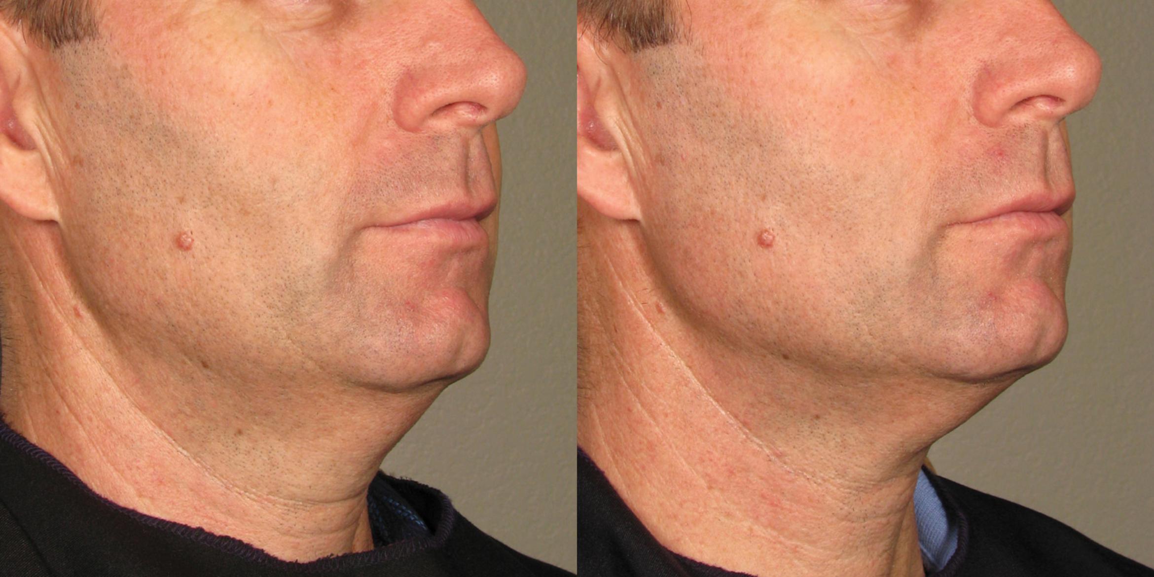 Ultherapy® Before & After Photo | New Jersey & Pennsylvania, | The Derm Group