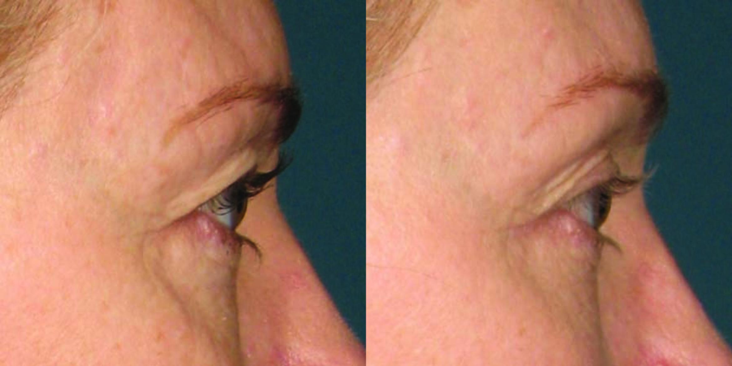 Ultherapy® Before & After Photo | Jersey City, New Jersey | The Derm Group
