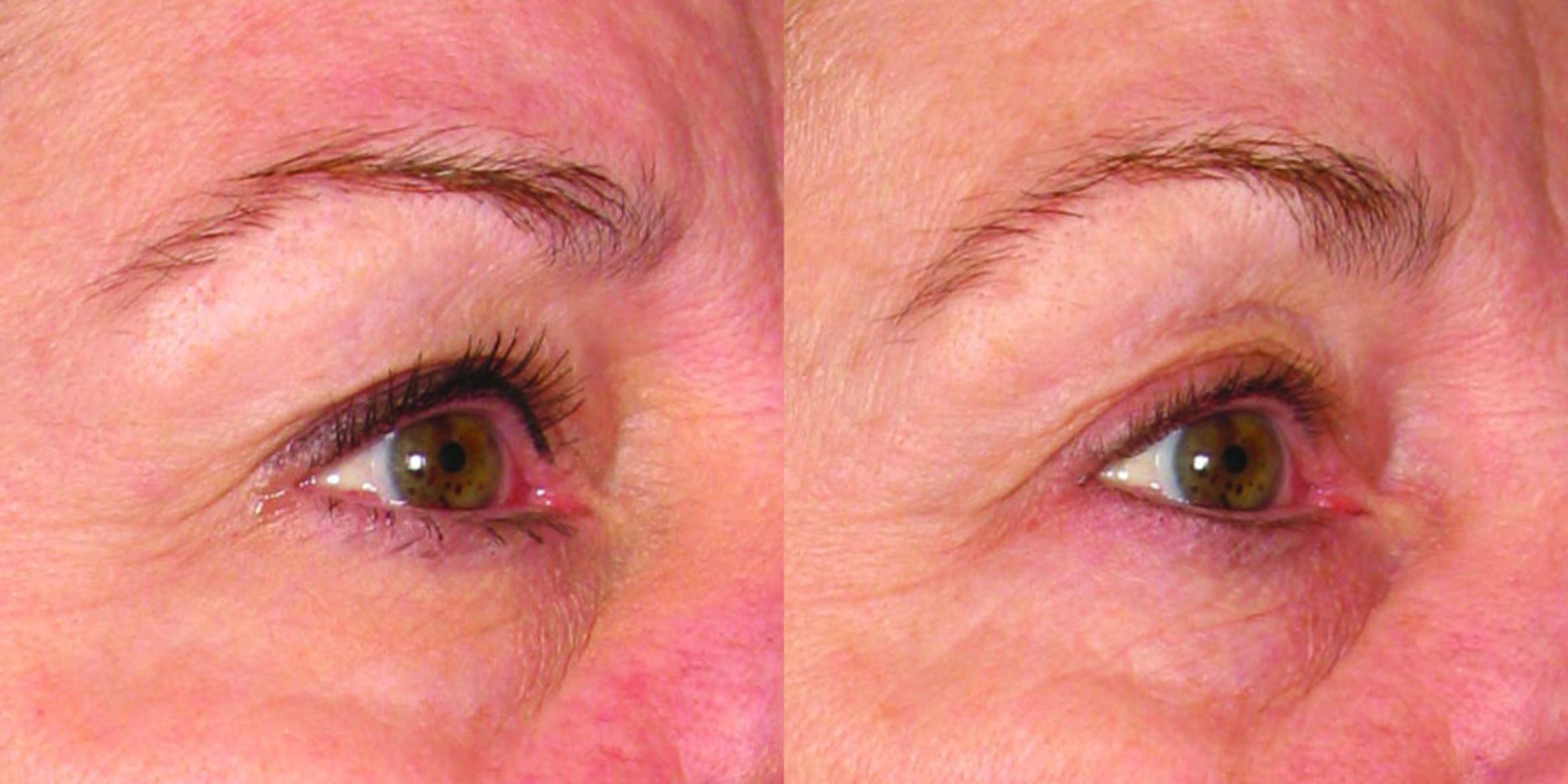 Ultherapy® Before & After Photo | Jersey City, New Jersey | The Derm Group