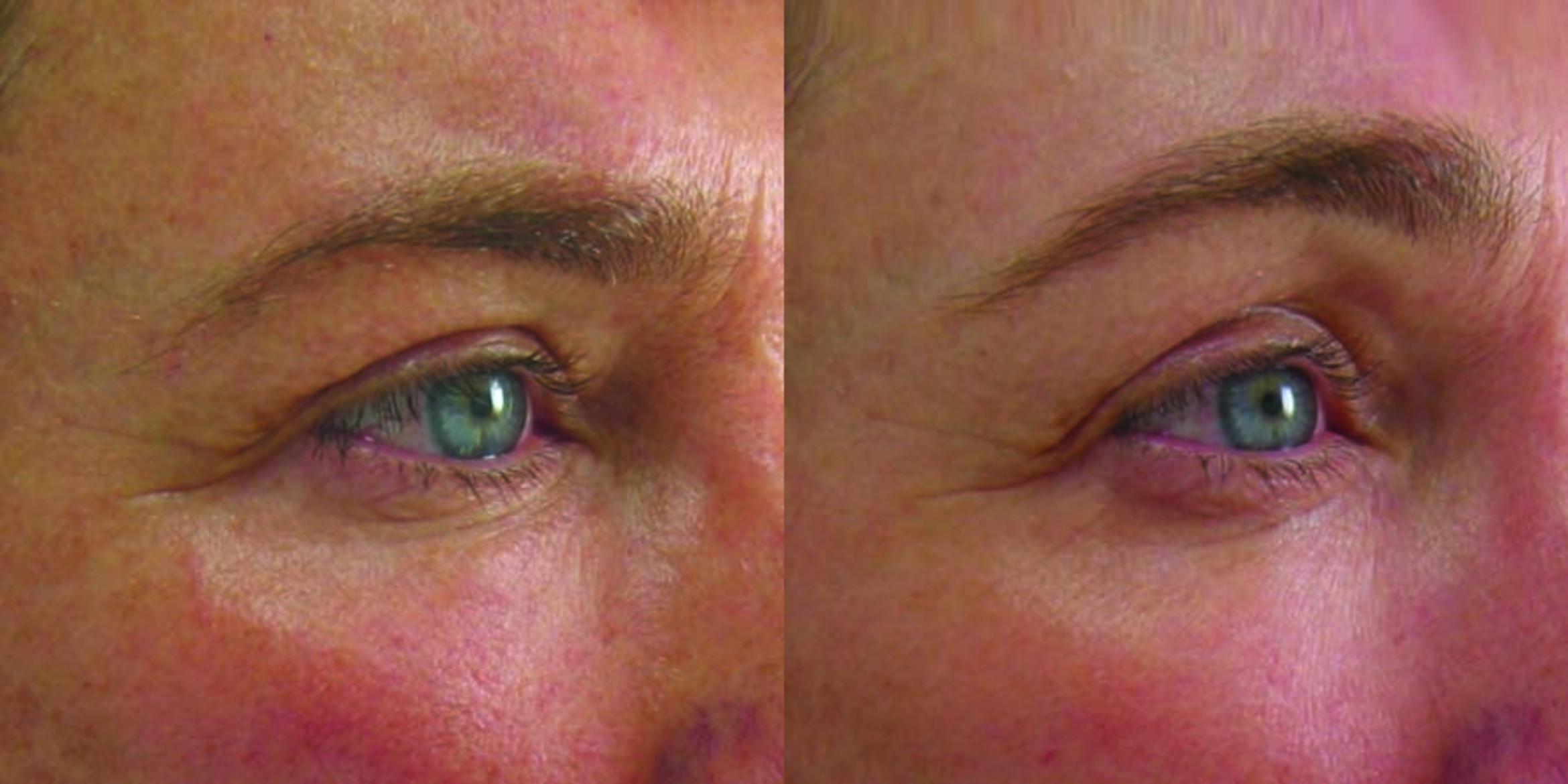 Ultherapy® Before & After Photo | Jersey City, New Jersey | The Derm Group