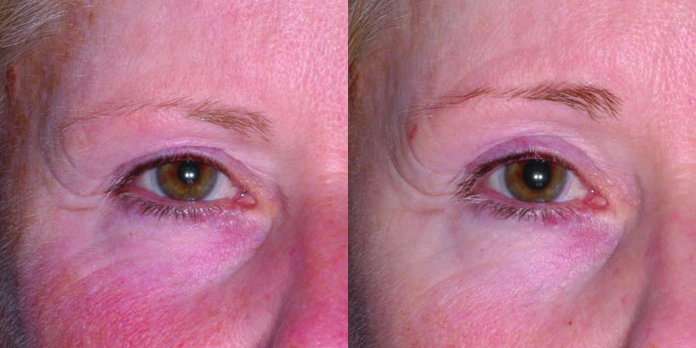 Ultherapy® Before & After Photo | Jersey City, New Jersey | The Derm Group