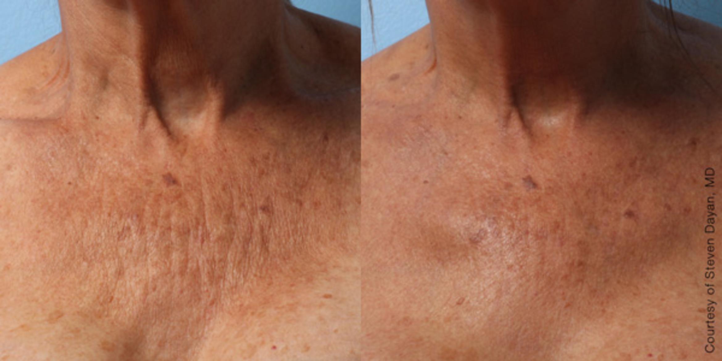 Ultherapy® Before & After Photo | Jersey City, New Jersey | The Derm Group