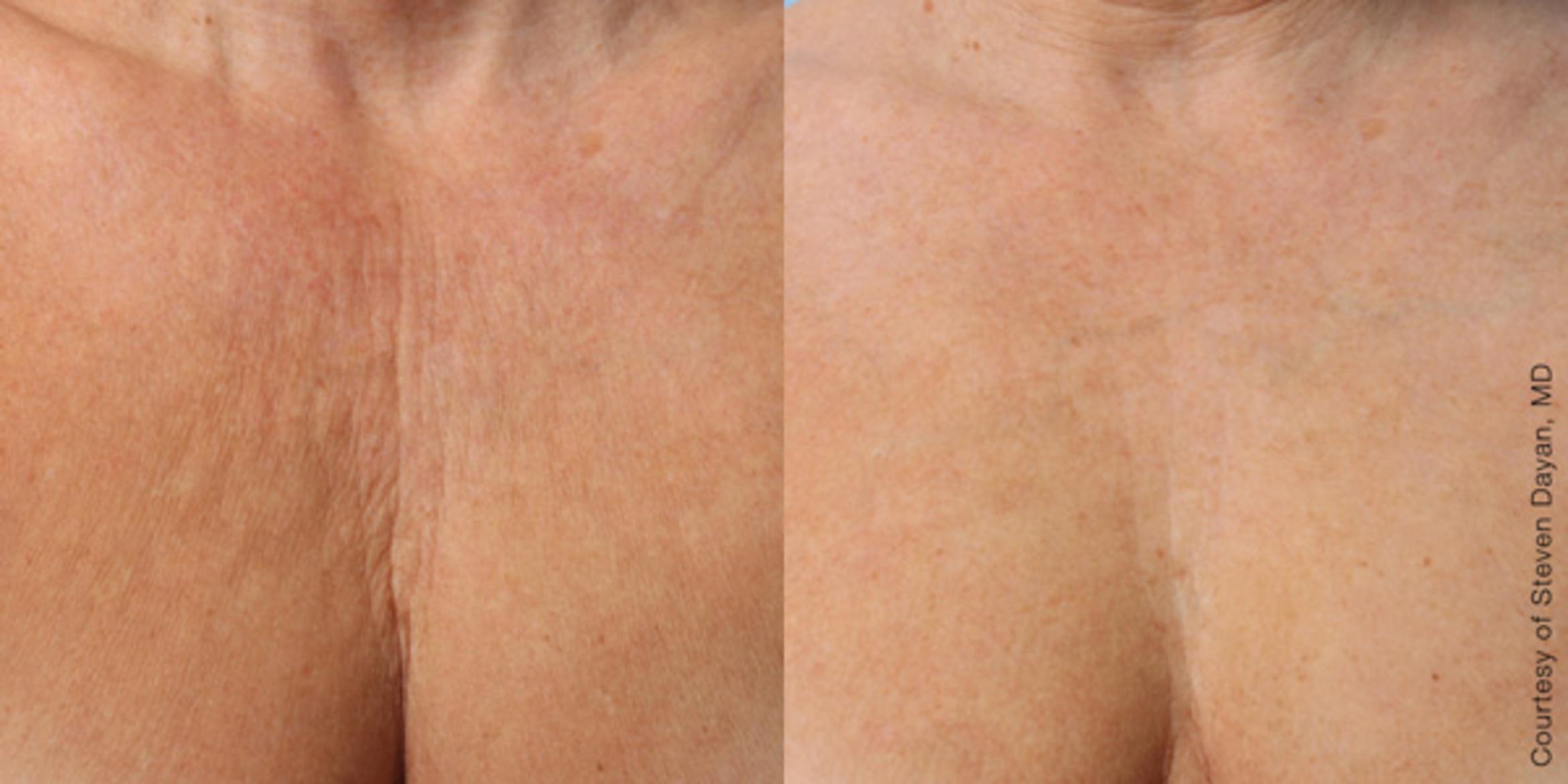 Ultherapy® Before & After Photo | Jersey City, New Jersey | The Derm Group