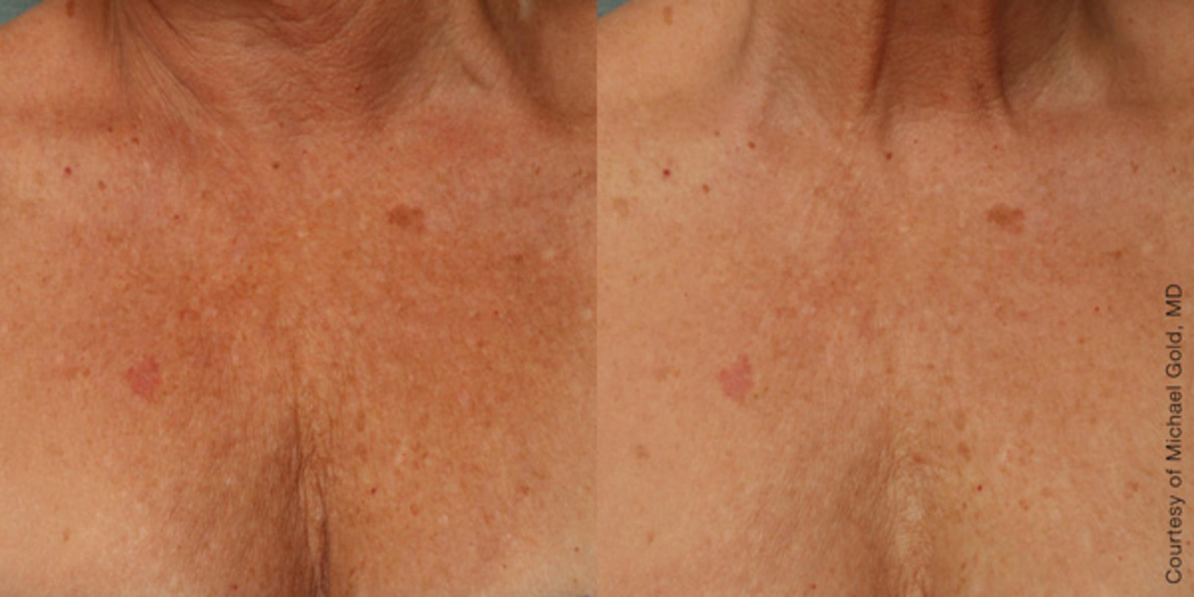 Ultherapy® Before & After Photo | Jersey City, New Jersey | The Derm Group