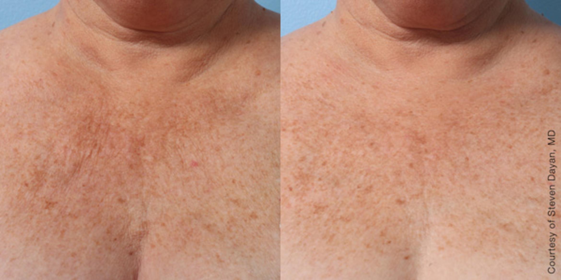Ultherapy® Before & After Photo | Jersey City, New Jersey | The Derm Group
