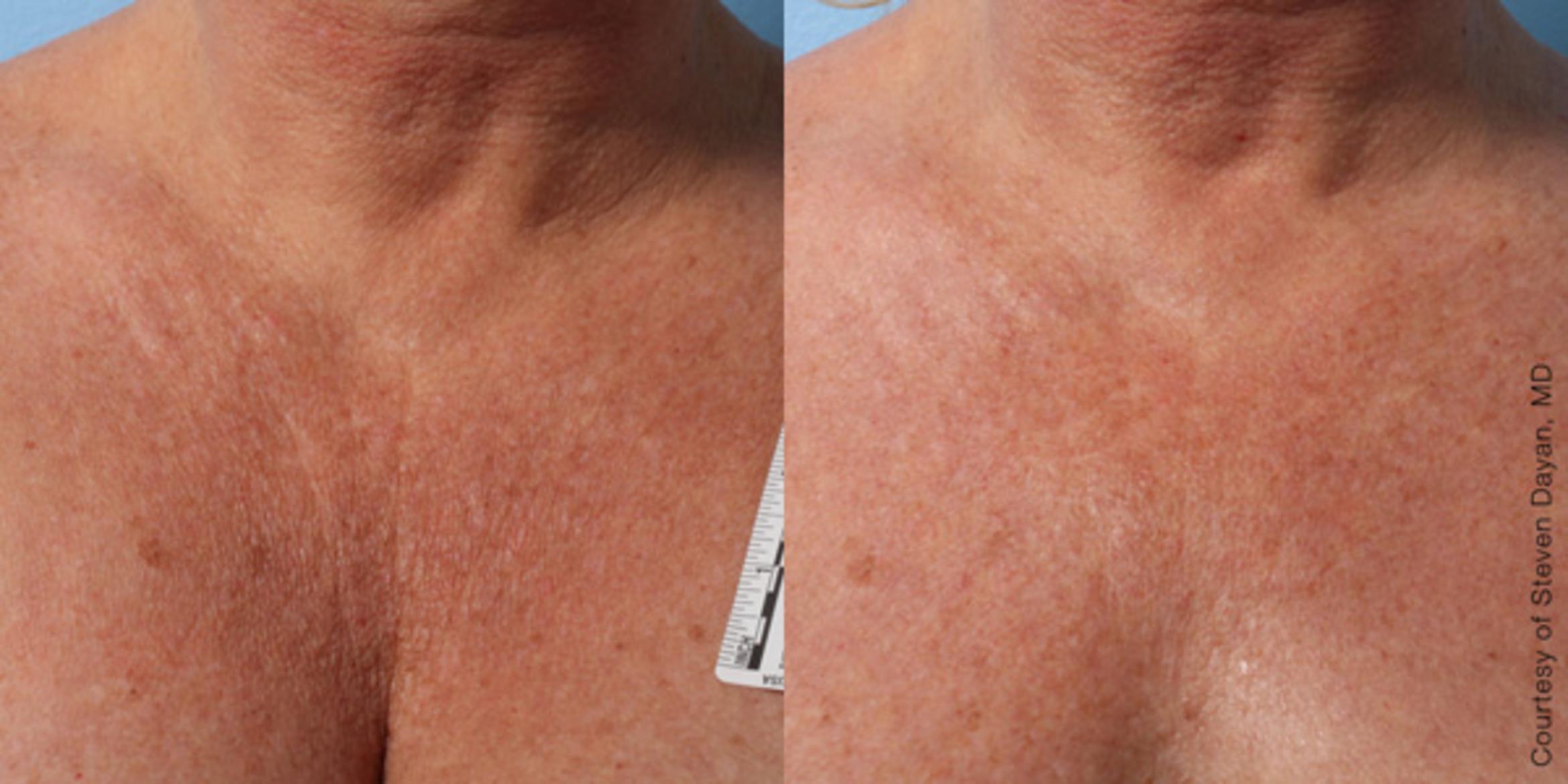 Ultherapy® Before & After Photo | Jersey City, New Jersey | The Derm Group
