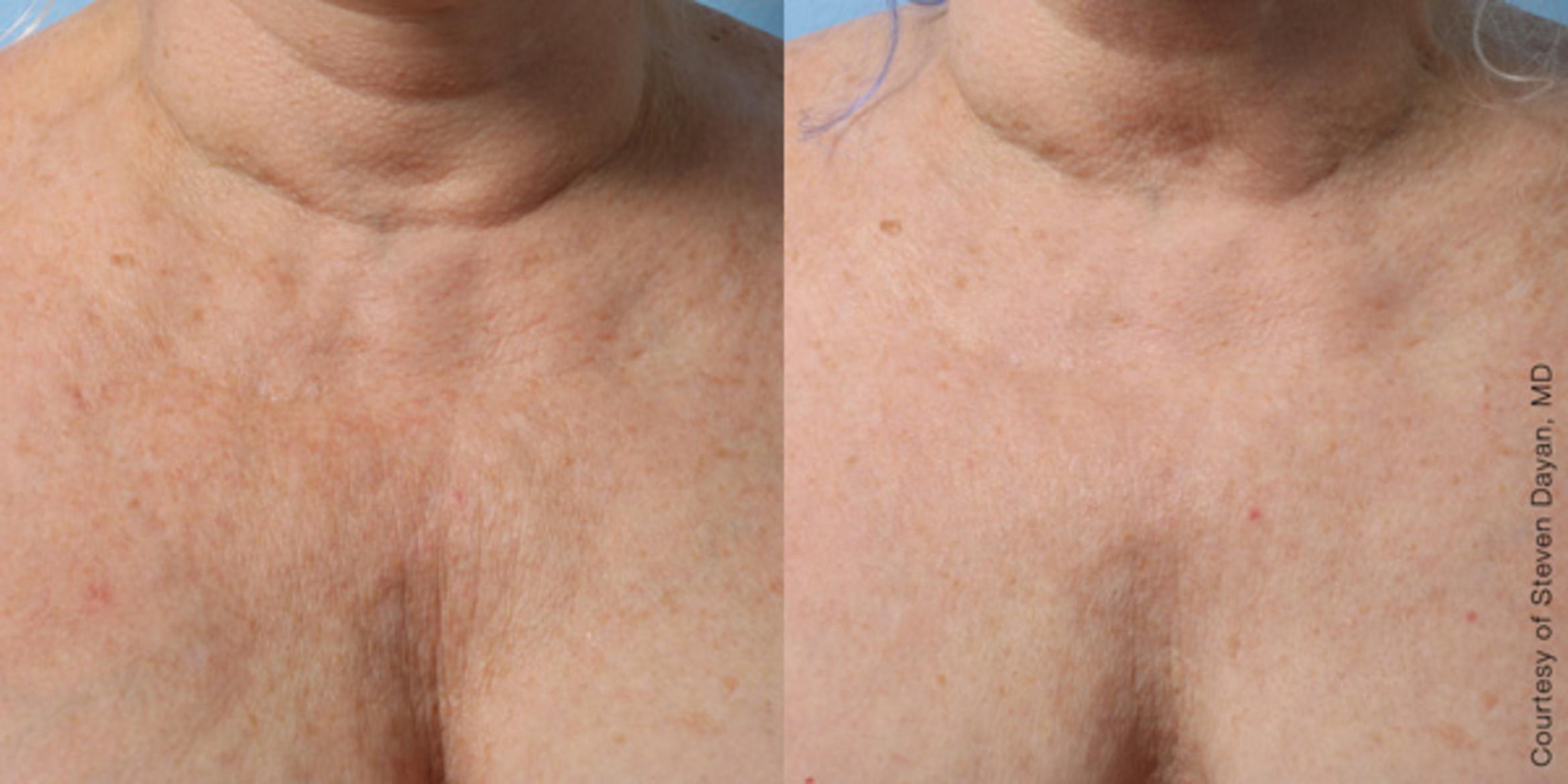 Ultherapy® Before & After Photo | Jersey City, New Jersey | The Derm Group