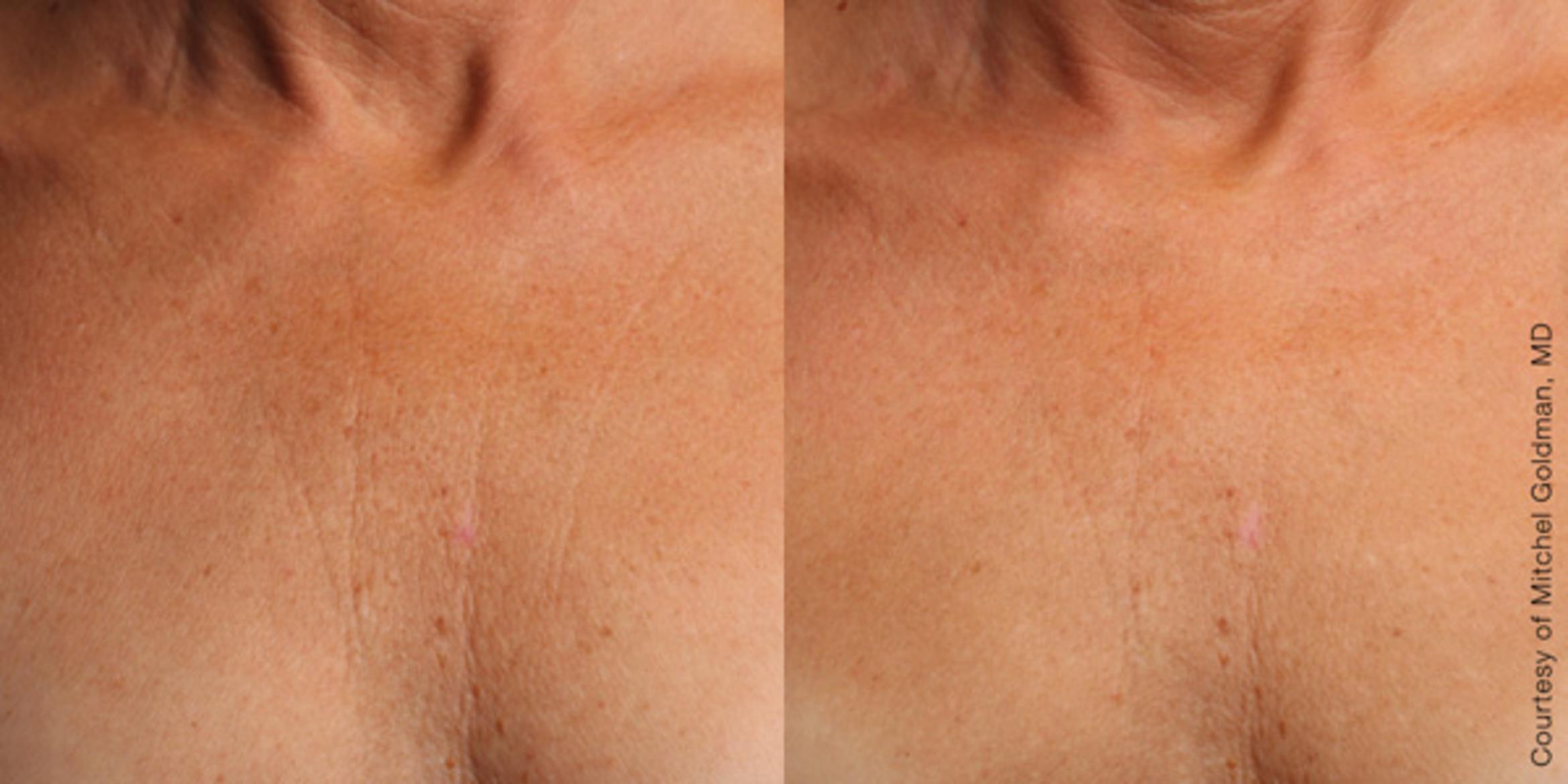 Ultherapy® Before & After Photo | Jersey City, New Jersey | The Derm Group