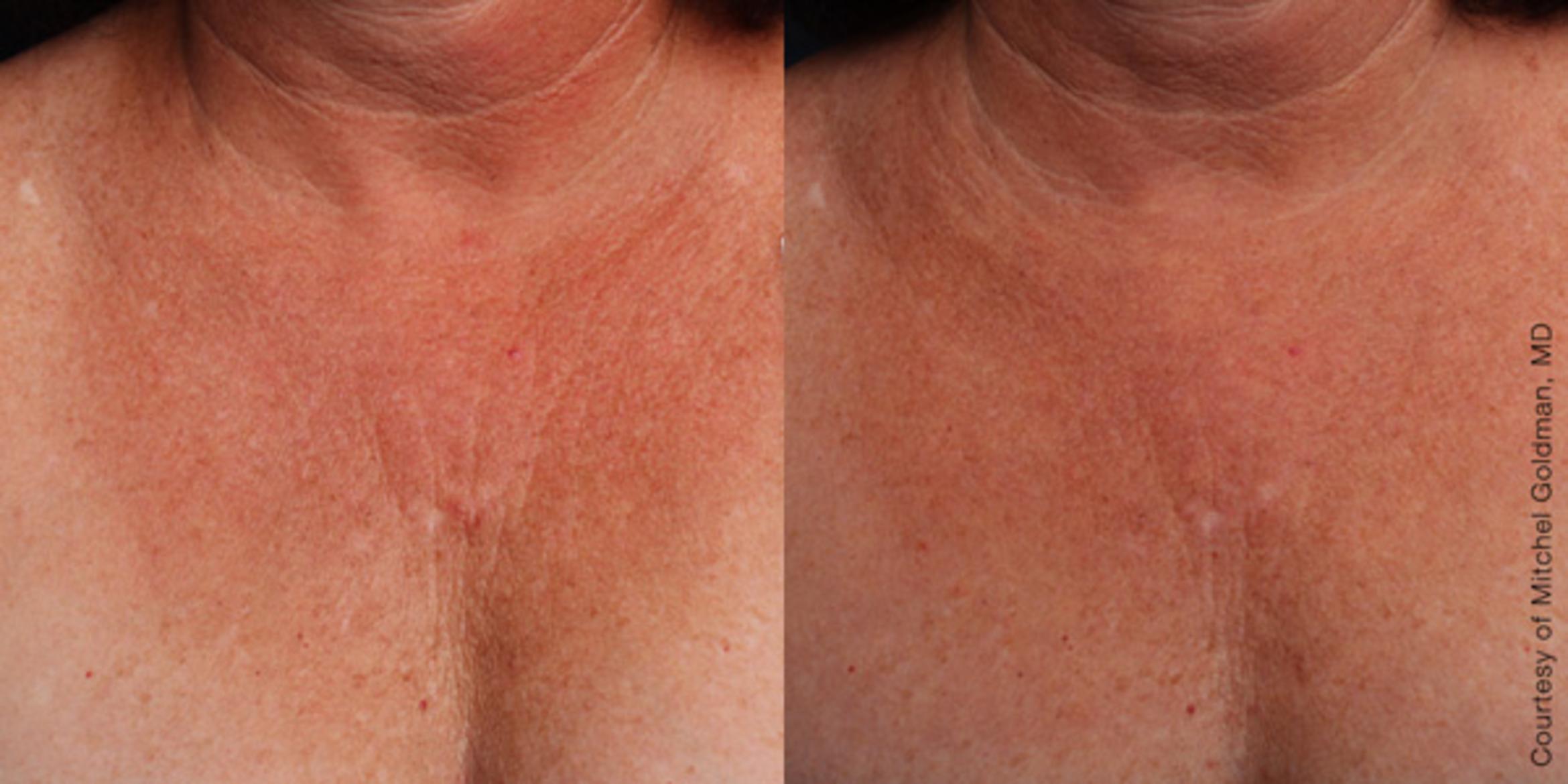Ultherapy® Before & After Photo | Jersey City, New Jersey | The Derm Group