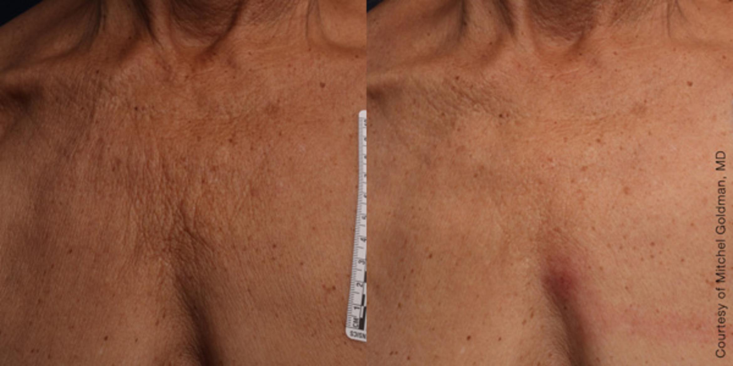 Ultherapy® Before & After Photo | Jersey City, New Jersey | The Derm Group