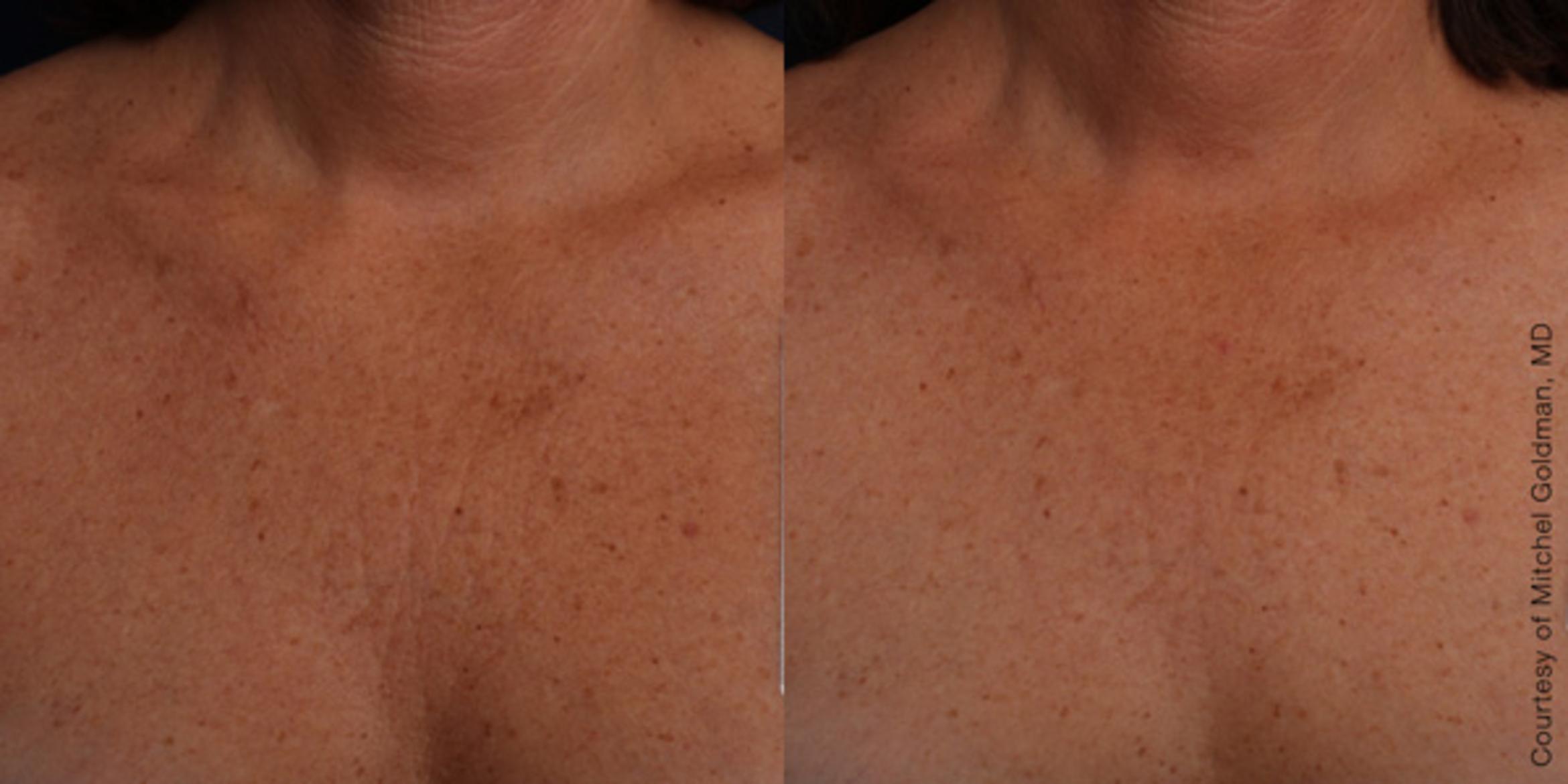 Ultherapy® Before & After Photo | Jersey City, New Jersey | The Derm Group