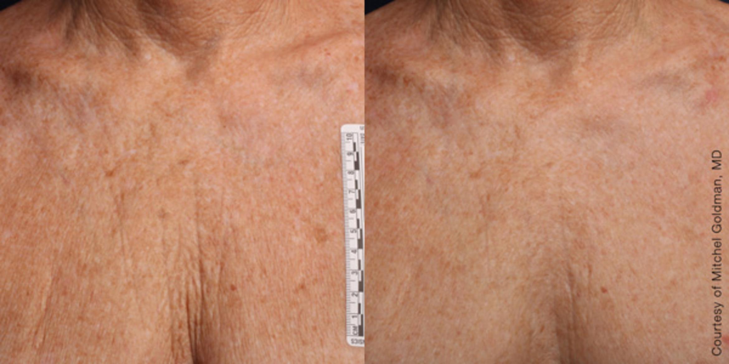 Ultherapy® Before & After Photo | Jersey City, New Jersey | The Derm Group