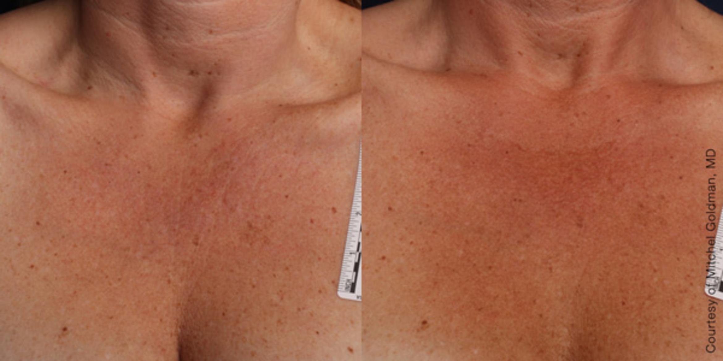 Ultherapy® Before & After Photo | Jersey City, New Jersey | The Derm Group