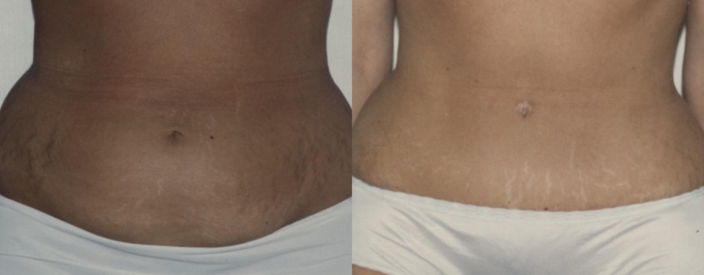 Abdominoplasty (Tummy Tuck) Before & After Photo | New Jersey & Pennsylvania,  | The Derm Group