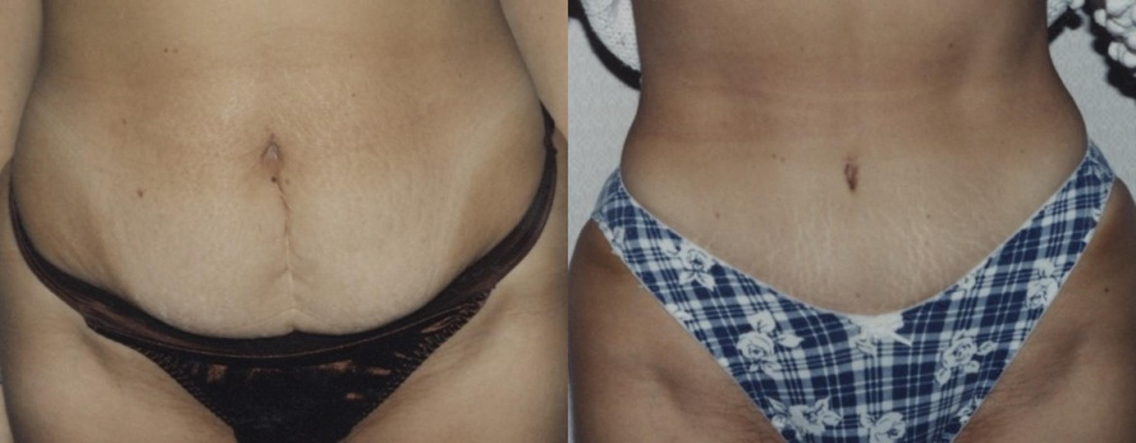 Abdominoplasty (Tummy Tuck) Before & After Photo | New Jersey & Pennsylvania,  | The Derm Group