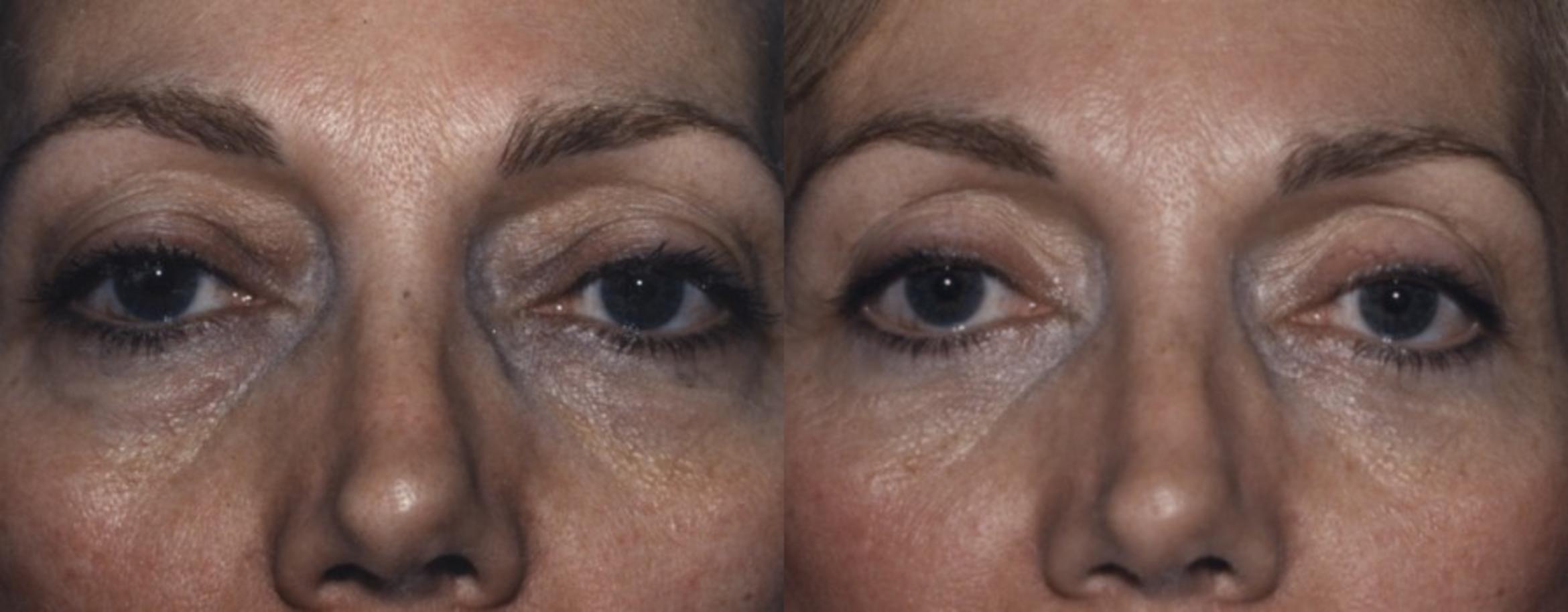 Blepharoplasty Before & After Photos Patient 43 | New Jersey