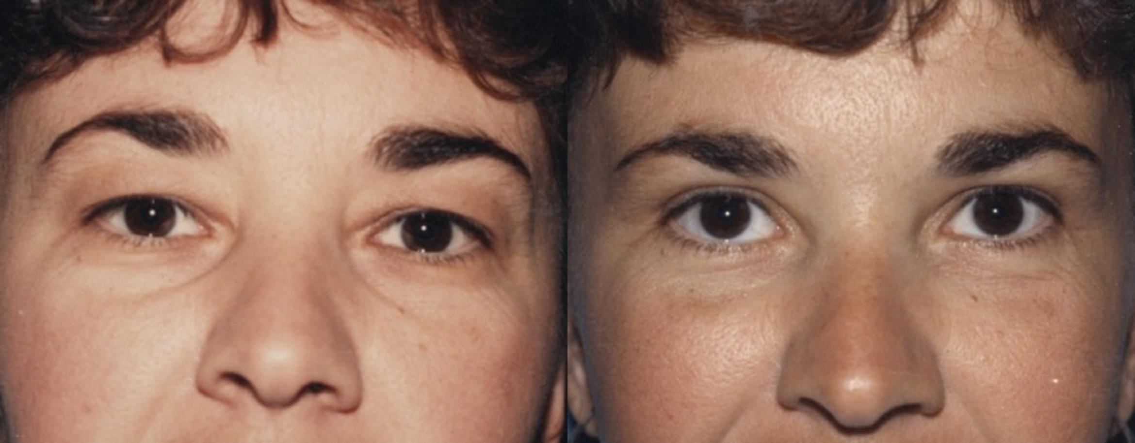 Blepharoplasty Before & After Photo | New Jersey & Pennsylvania,  | The Derm Group