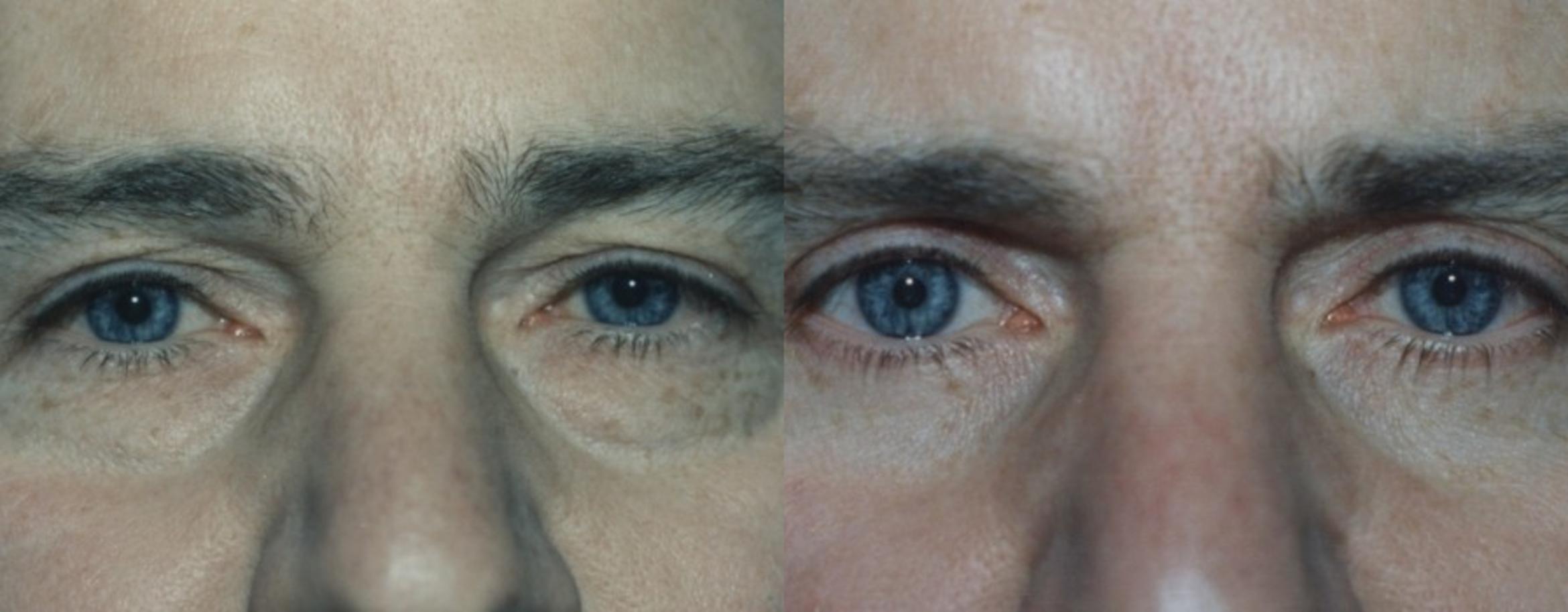 Blepharoplasty Before & After Photo | New Jersey & Pennsylvania,  | The Derm Group