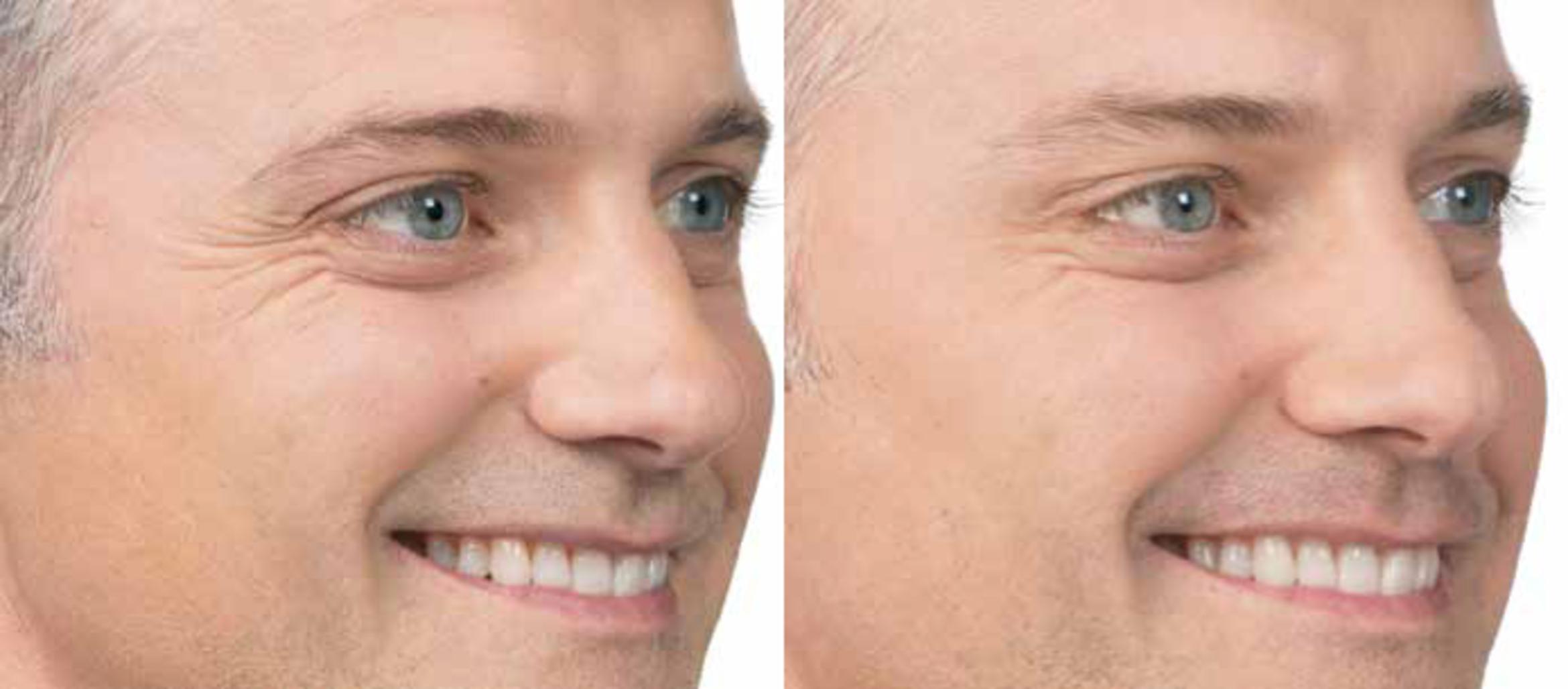BOTOX® Cosmetic Before & After Photo | New Jersey & Pennsylvania,  | The Derm Group