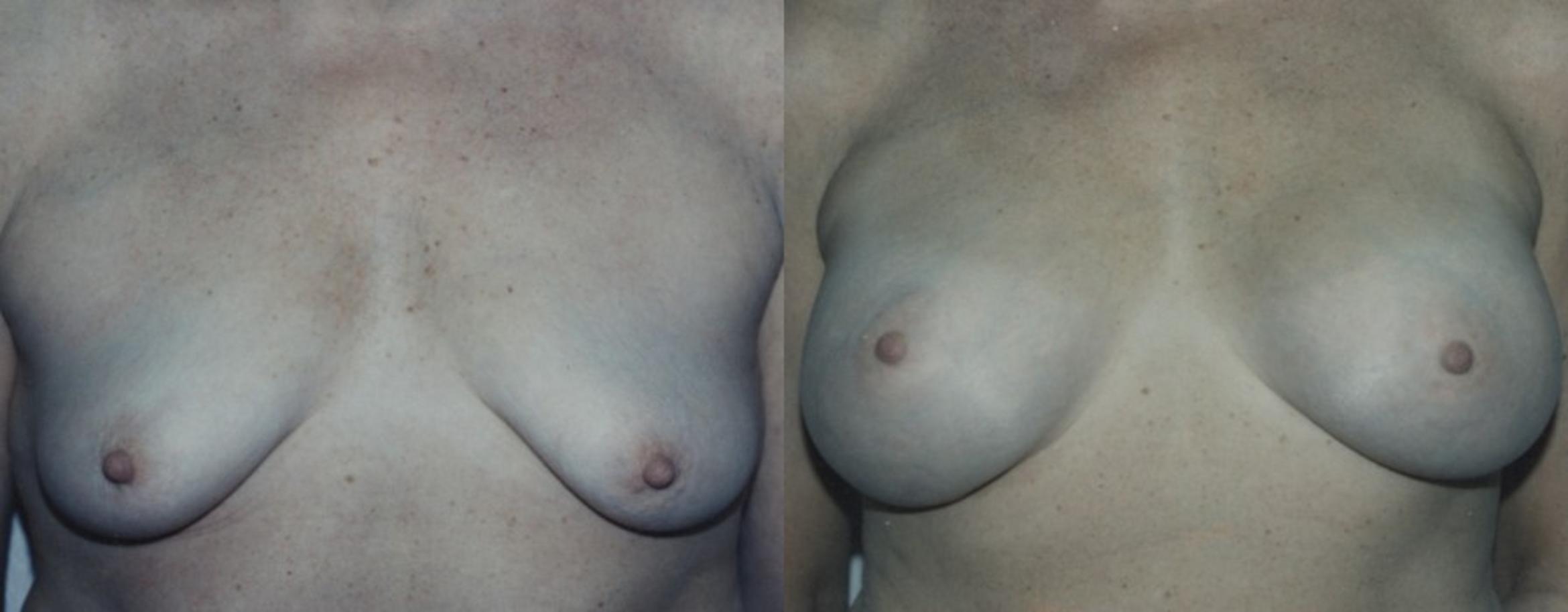 Breast Augmentation Before & After Photo | New Jersey & Pennsylvania,  | The Derm Group