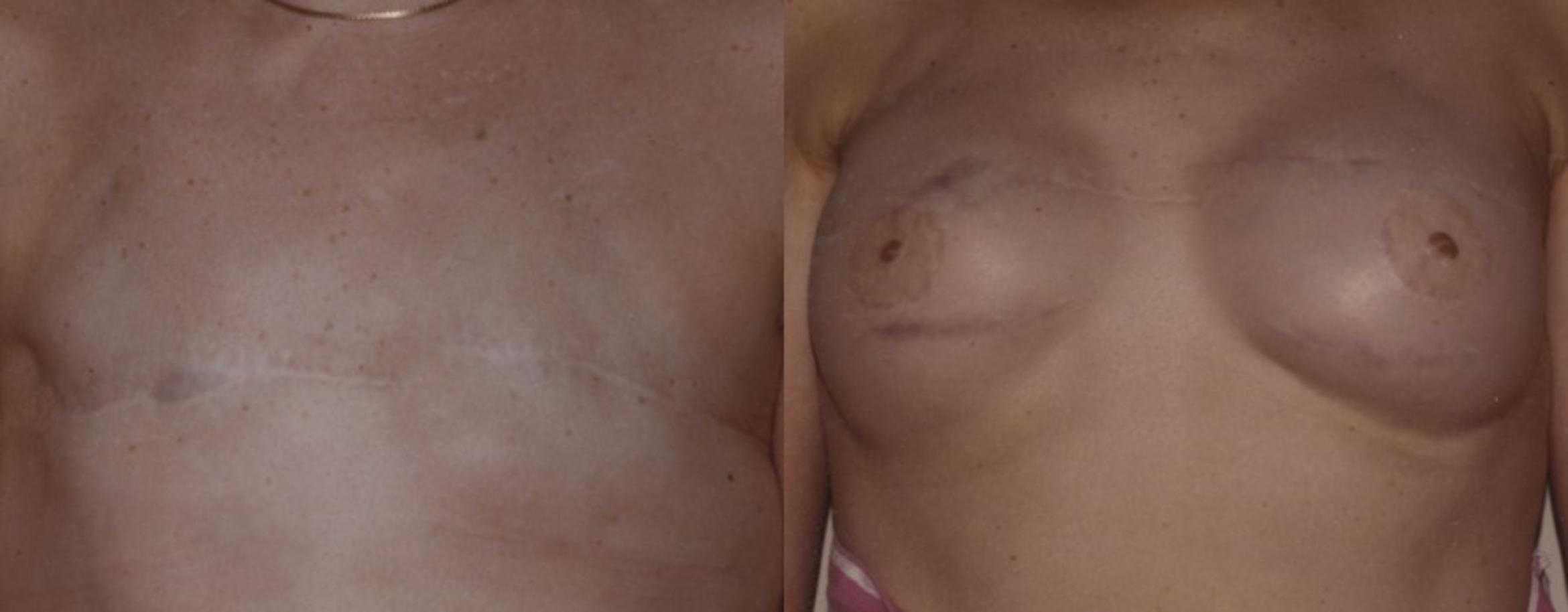 Breast Reconstruction Before & After Photo | New Jersey & Pennsylvania,  | The Derm Group