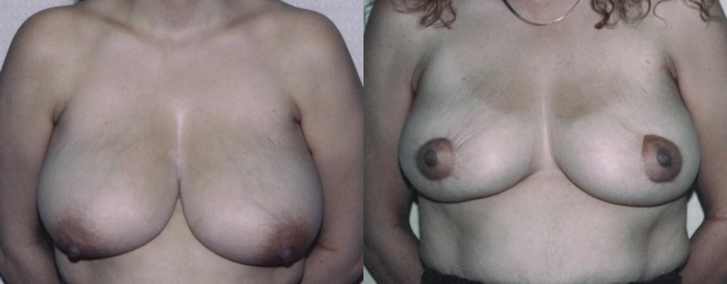 Breast Reduction Before & After Photo | New Jersey & Pennsylvania,  | The Derm Group