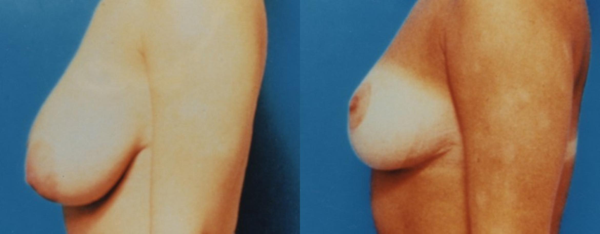 Breast Reduction Before & After Photo | New Jersey & Pennsylvania,  | The Derm Group