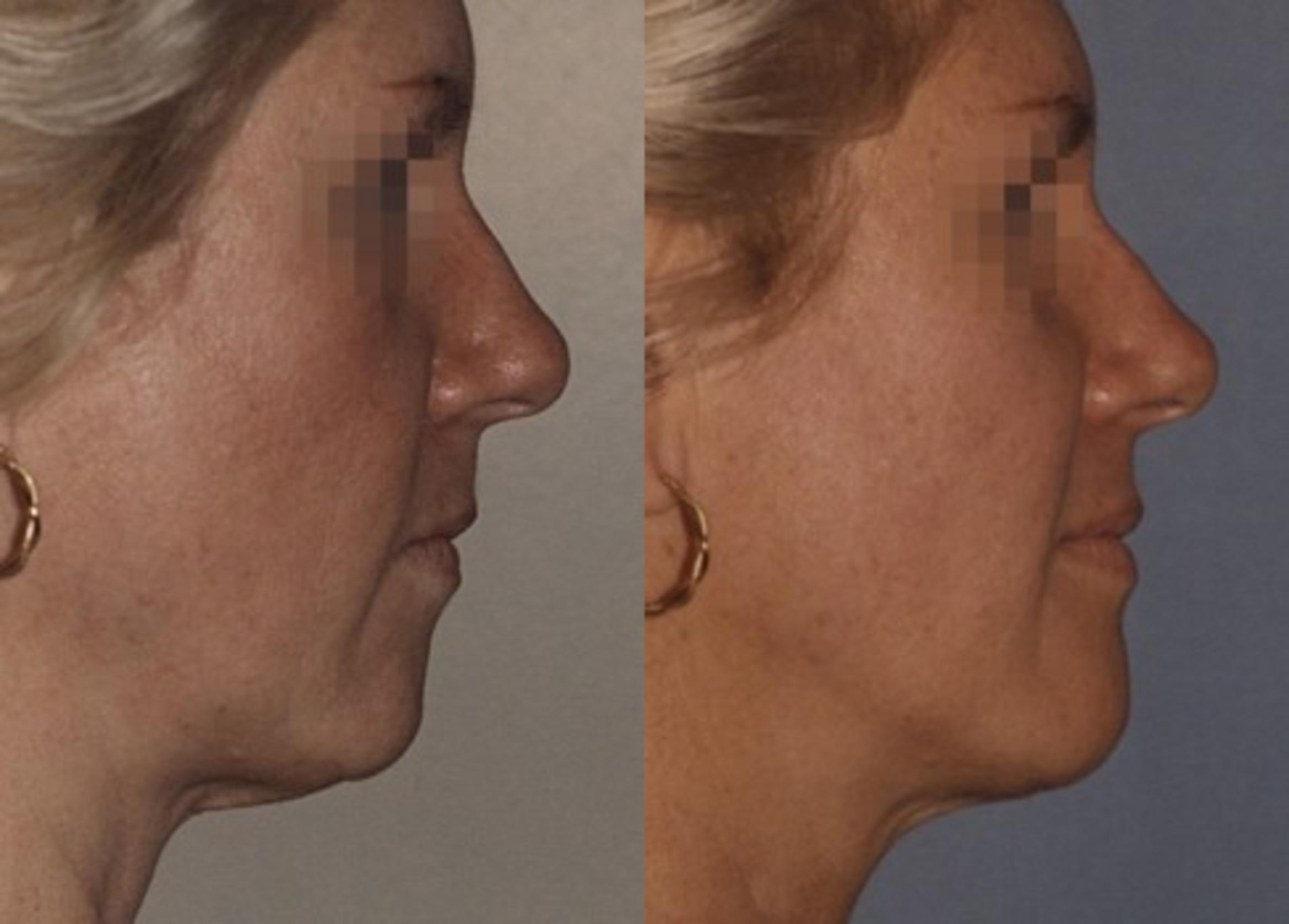 Chin Implant Before & After Photo | New Jersey & Pennsylvania,  | The Derm Group