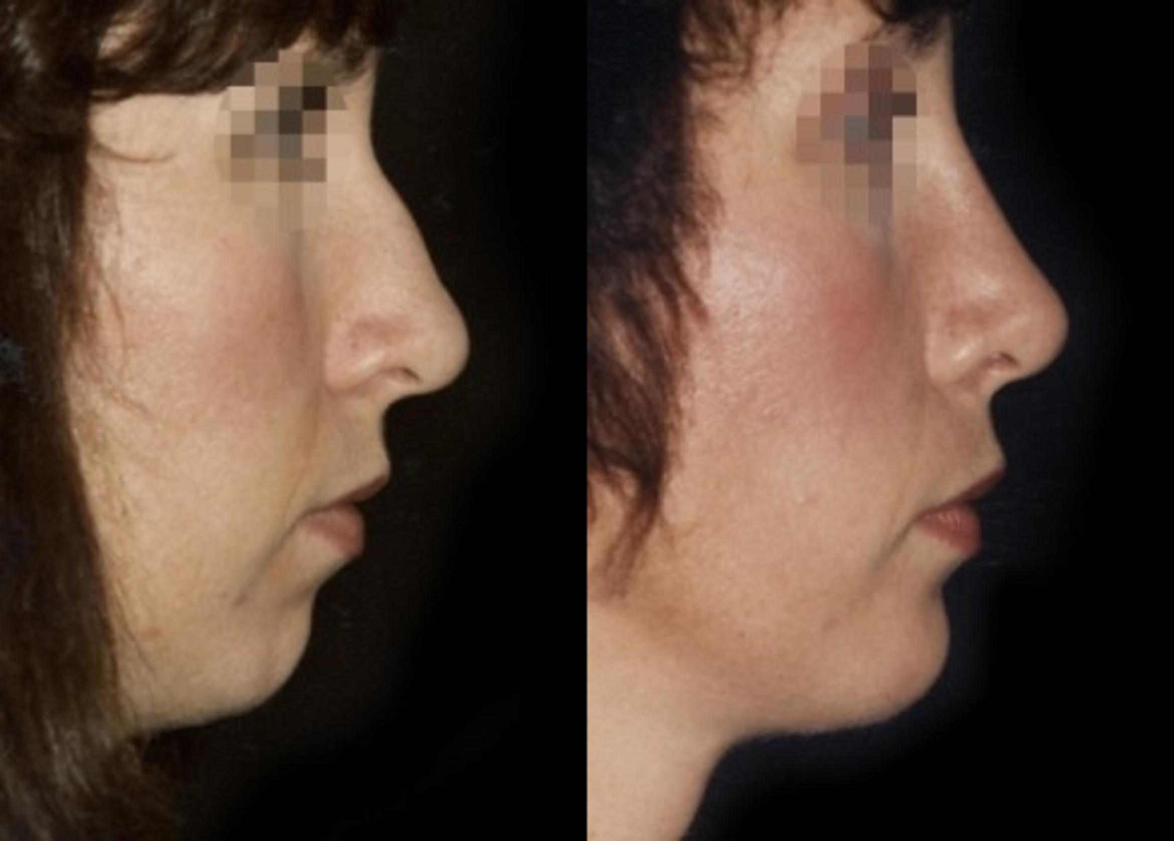 Chin Implant Before & After Photo | New Jersey & Pennsylvania,  | The Derm Group