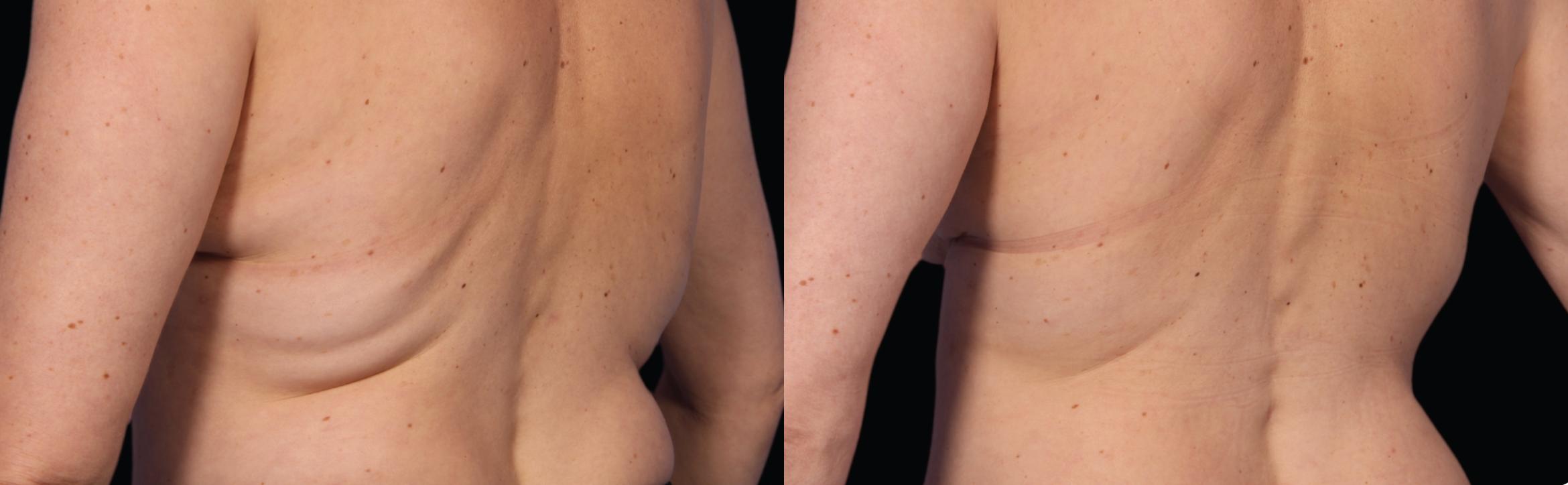 CoolSculpting® Before & After Photo | New Jersey & Pennsylvania,  | The Derm Group