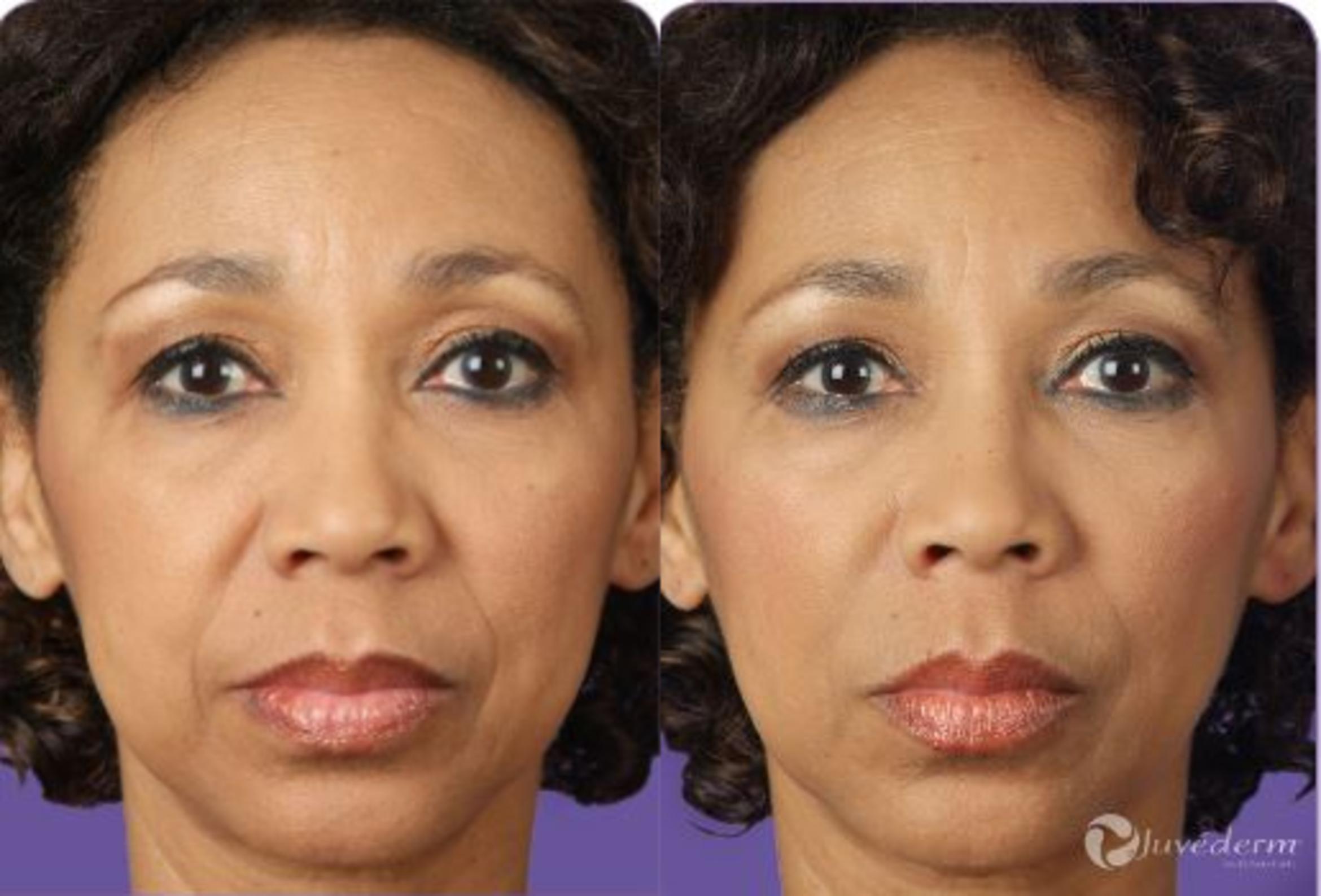 JUVÉDERM® Before & After Photo | New Jersey & Pennsylvania,  | The Derm Group