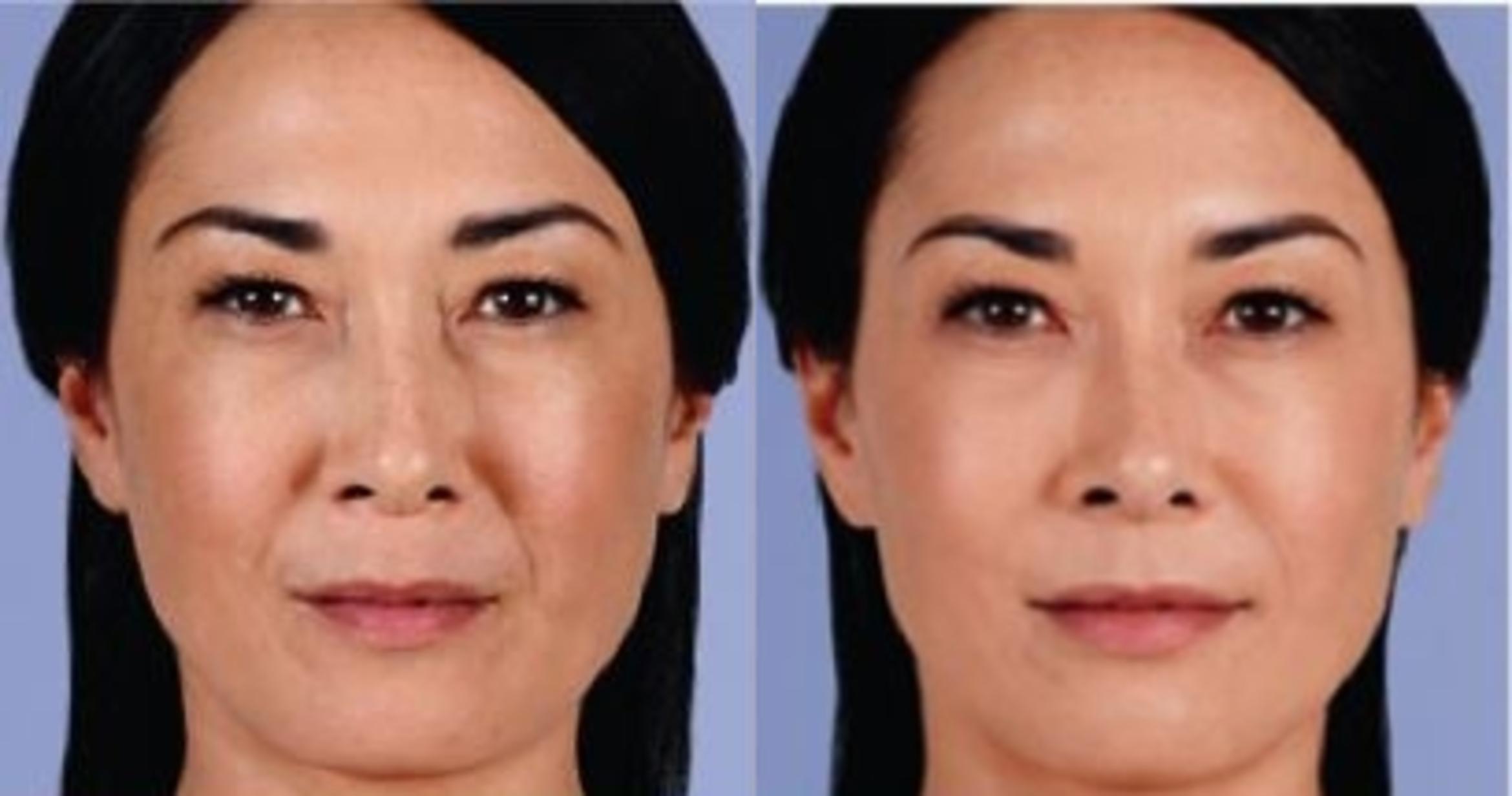 JUVÉDERM® Before & After Photo | New Jersey & Pennsylvania,  | The Derm Group