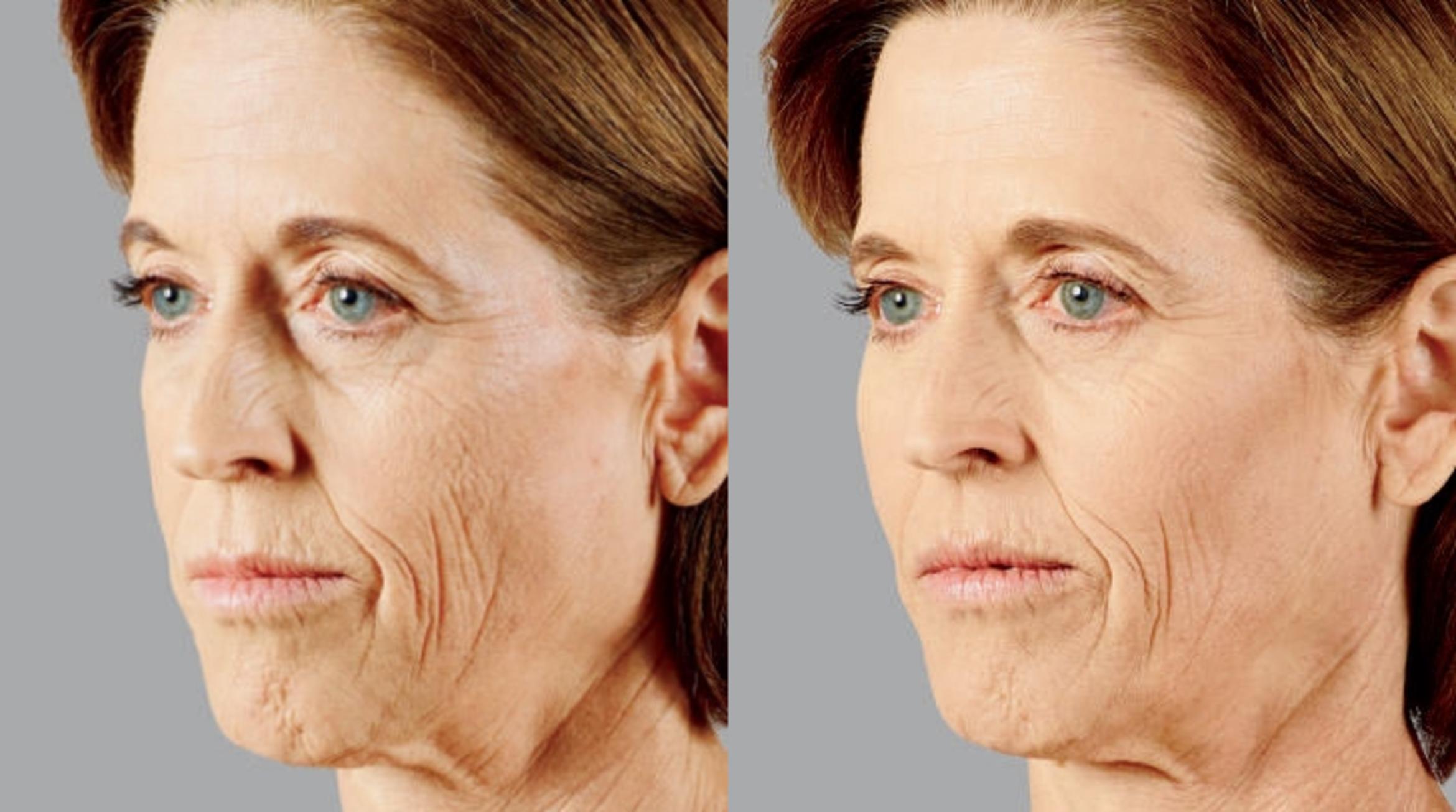 chin filler before and after